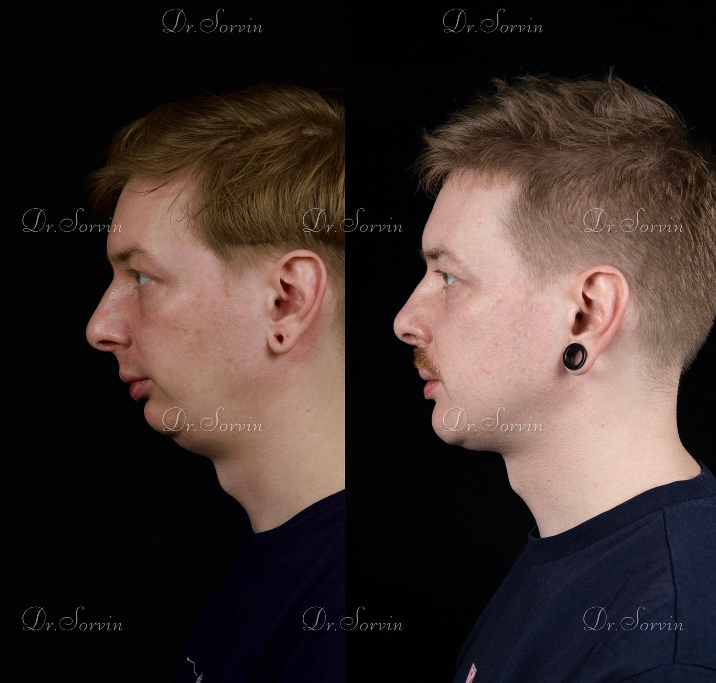 Class II skeletal malocclusion — 6 — before and after, photo 3