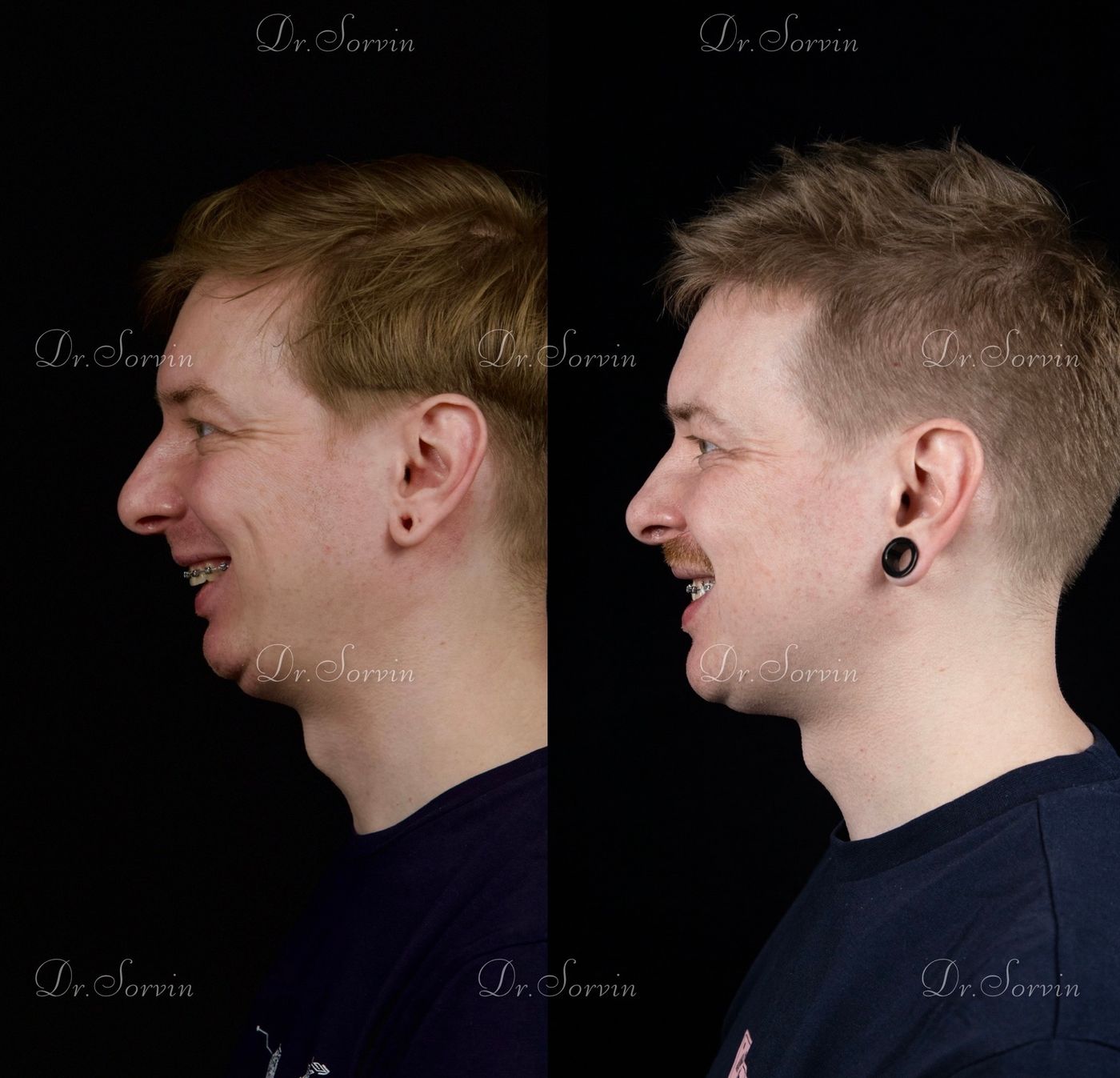 Class II skeletal malocclusion — 6 — before and after, photo 4