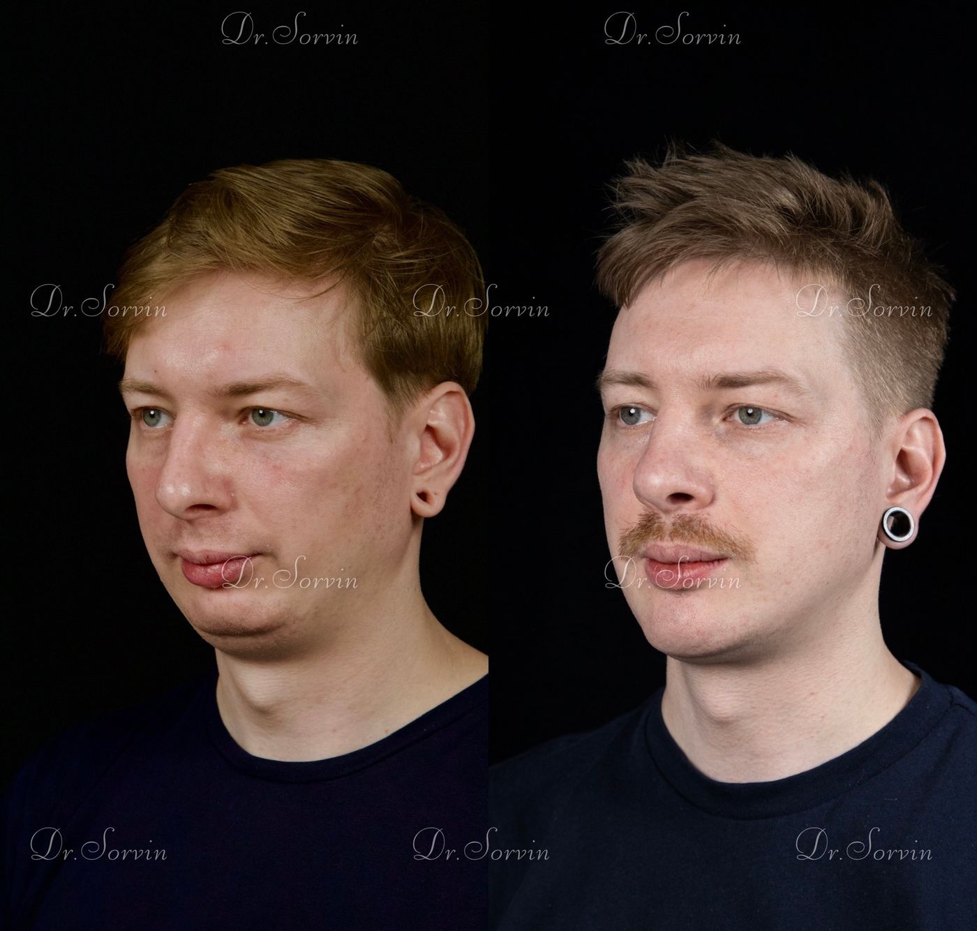 Class II skeletal malocclusion — 6 — before and after, photo 5