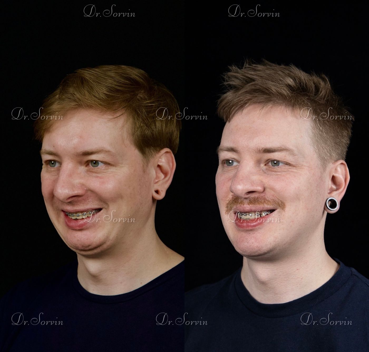 Class II skeletal malocclusion — 6 — before and after, photo 6
