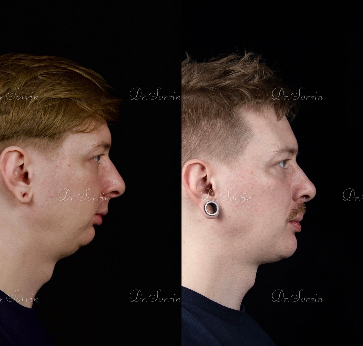 Class II skeletal malocclusion — 6 — before and after, photo 7