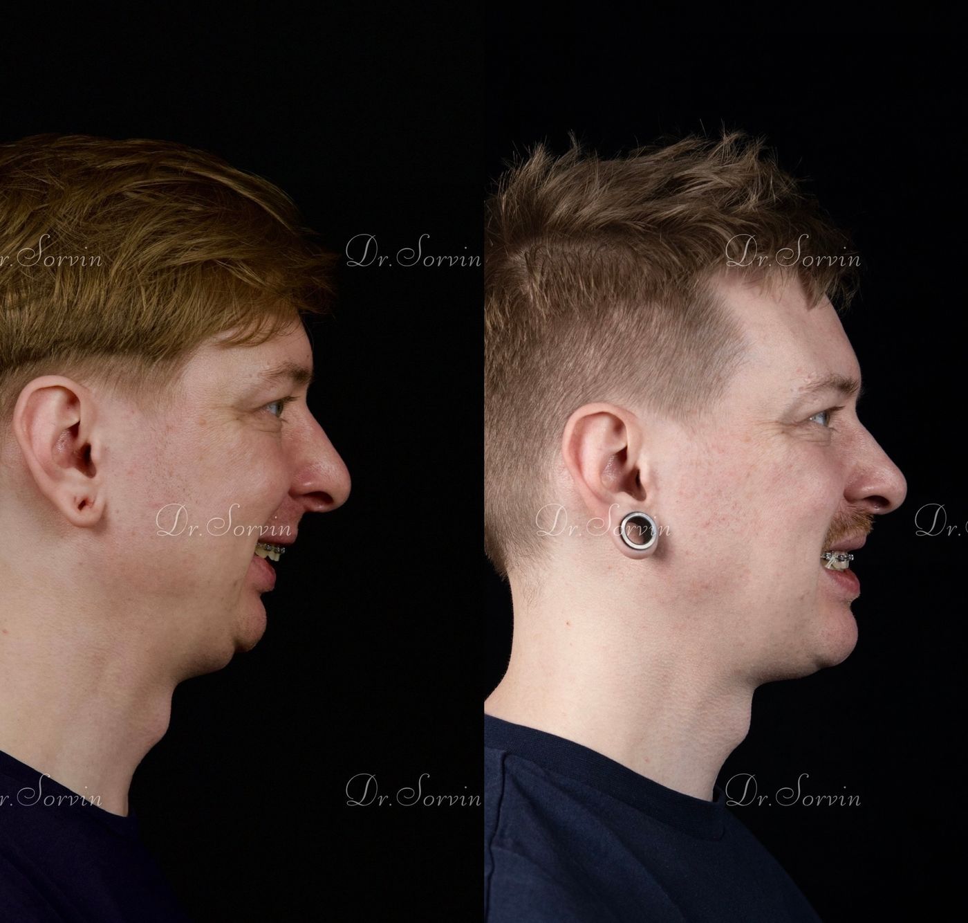 Class II skeletal malocclusion — 6 — before and after, photo 8
