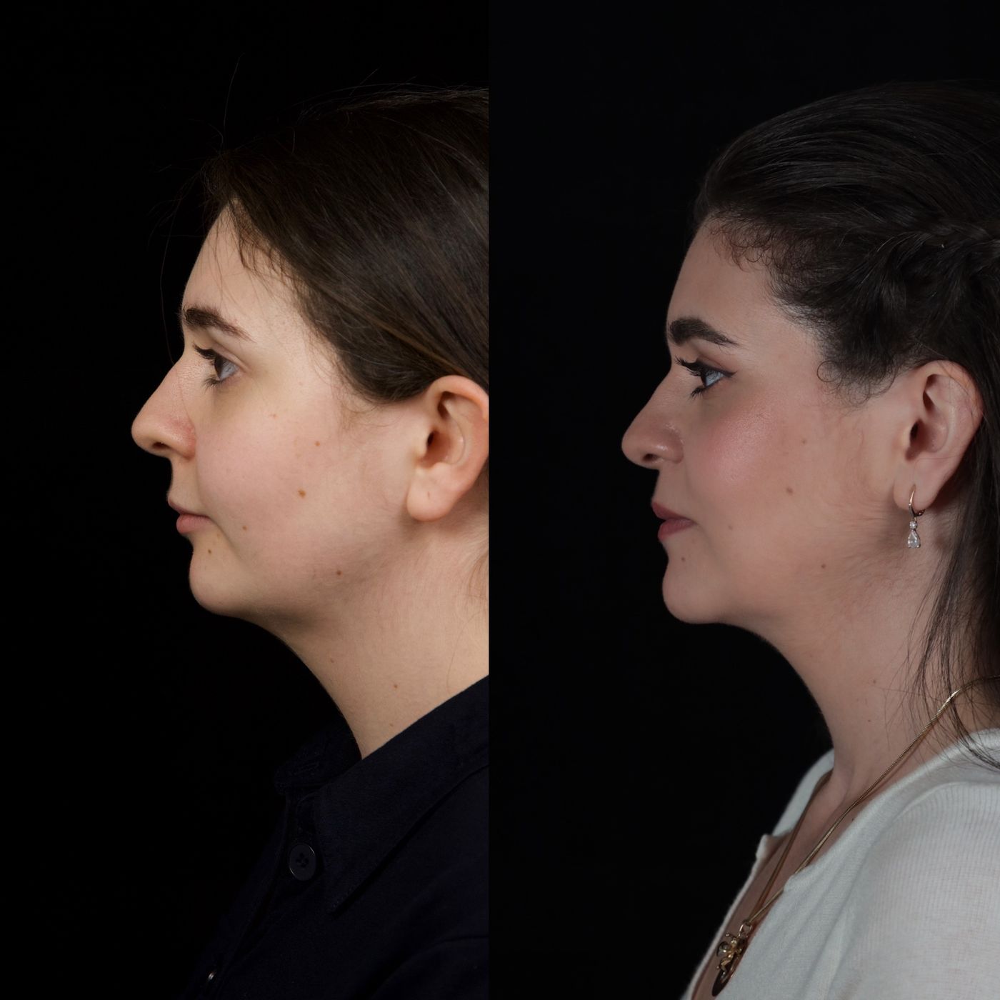 Class II skeletal malocclusion — 2 — before and after, photo 1
