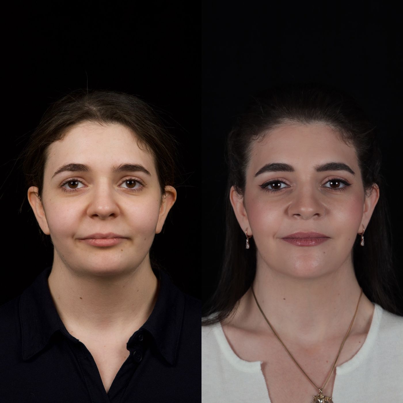 Class II skeletal malocclusion — 2 — before and after, photo 2