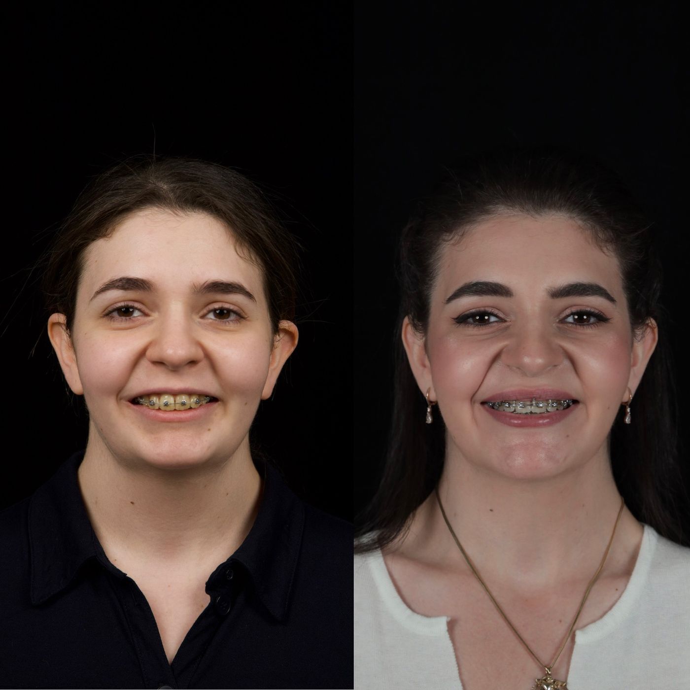 Class II skeletal malocclusion — 2 — before and after, photo 3