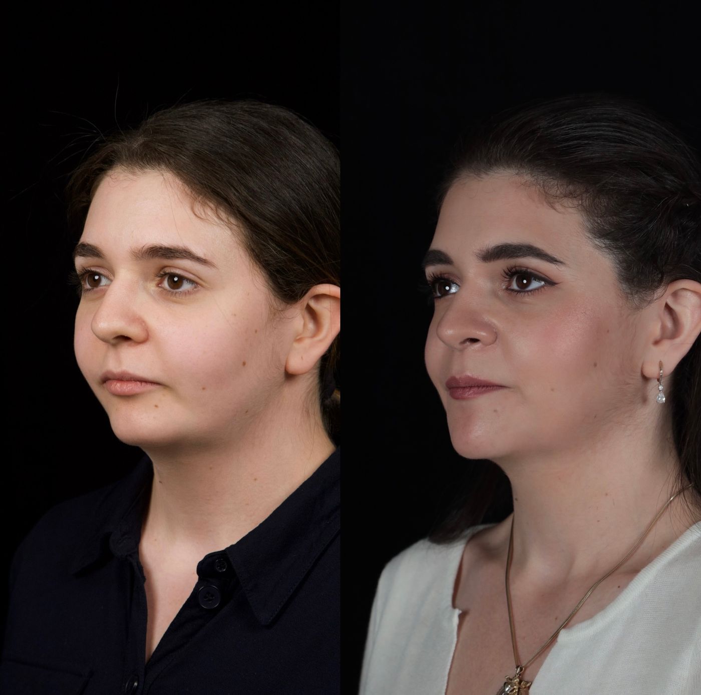 Class II skeletal malocclusion — 2 — before and after, photo 4
