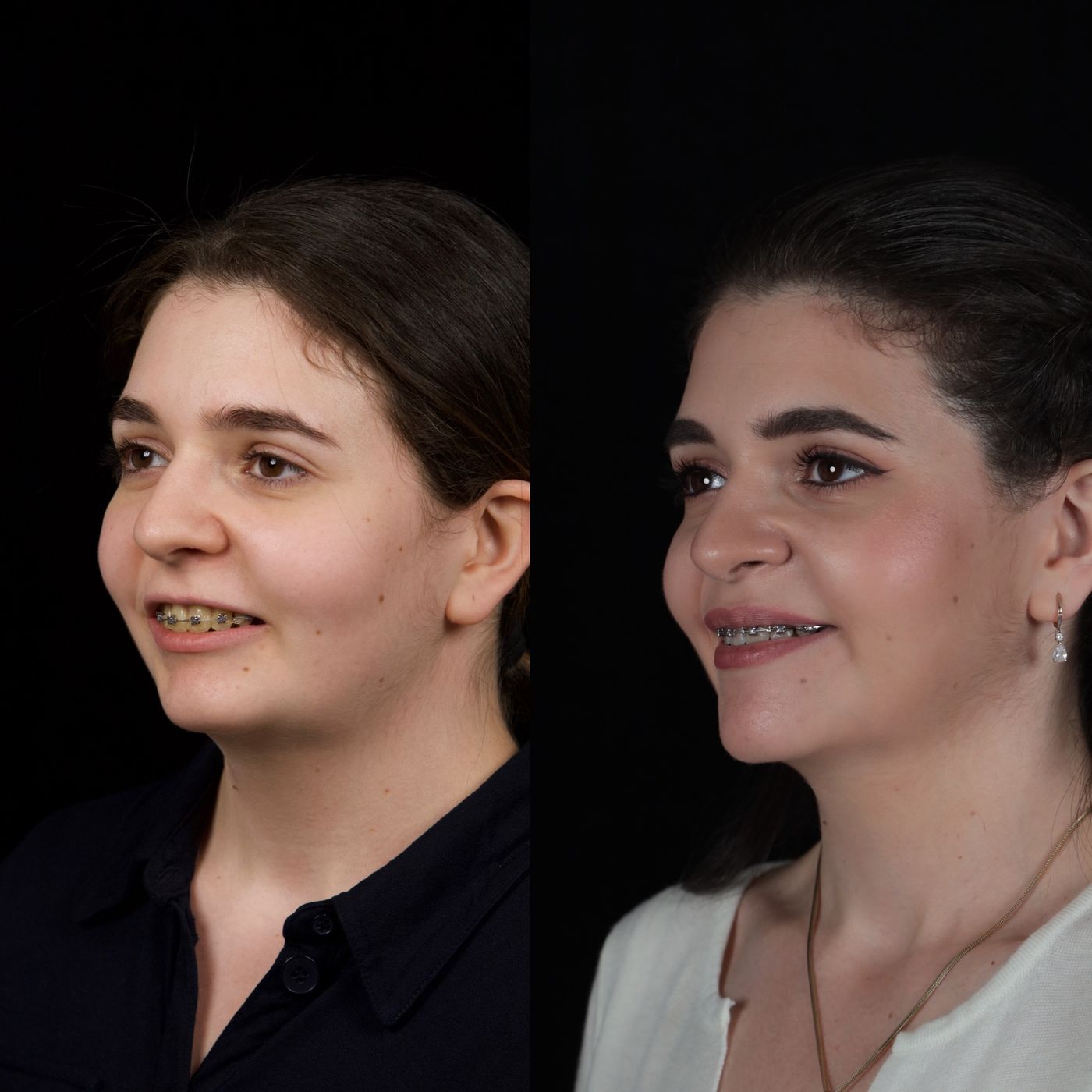 Class II skeletal malocclusion — 2 — before and after, photo 5