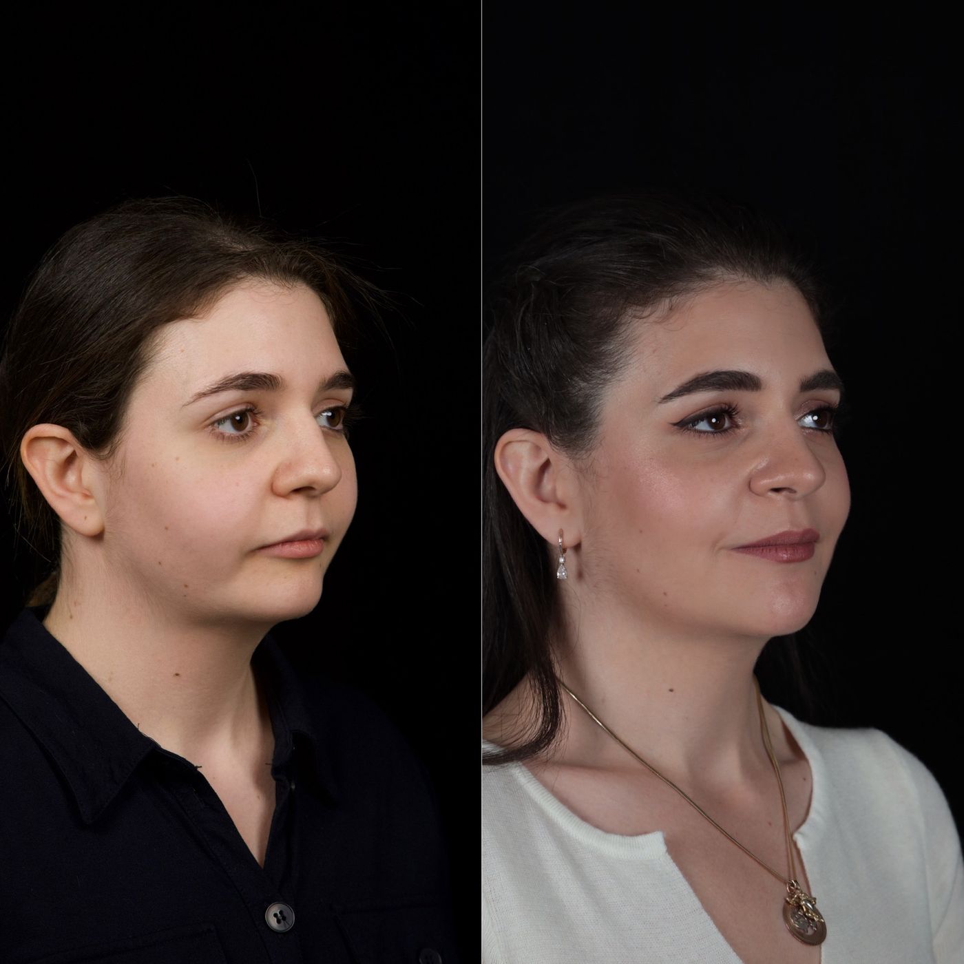 Class II skeletal malocclusion — 2 — before and after, photo 6