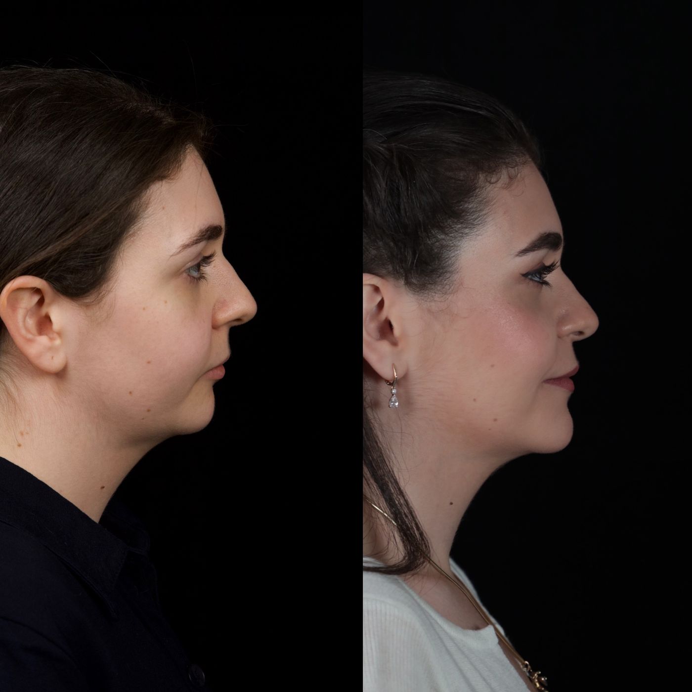 Class II skeletal malocclusion — 2 — before and after, photo 7