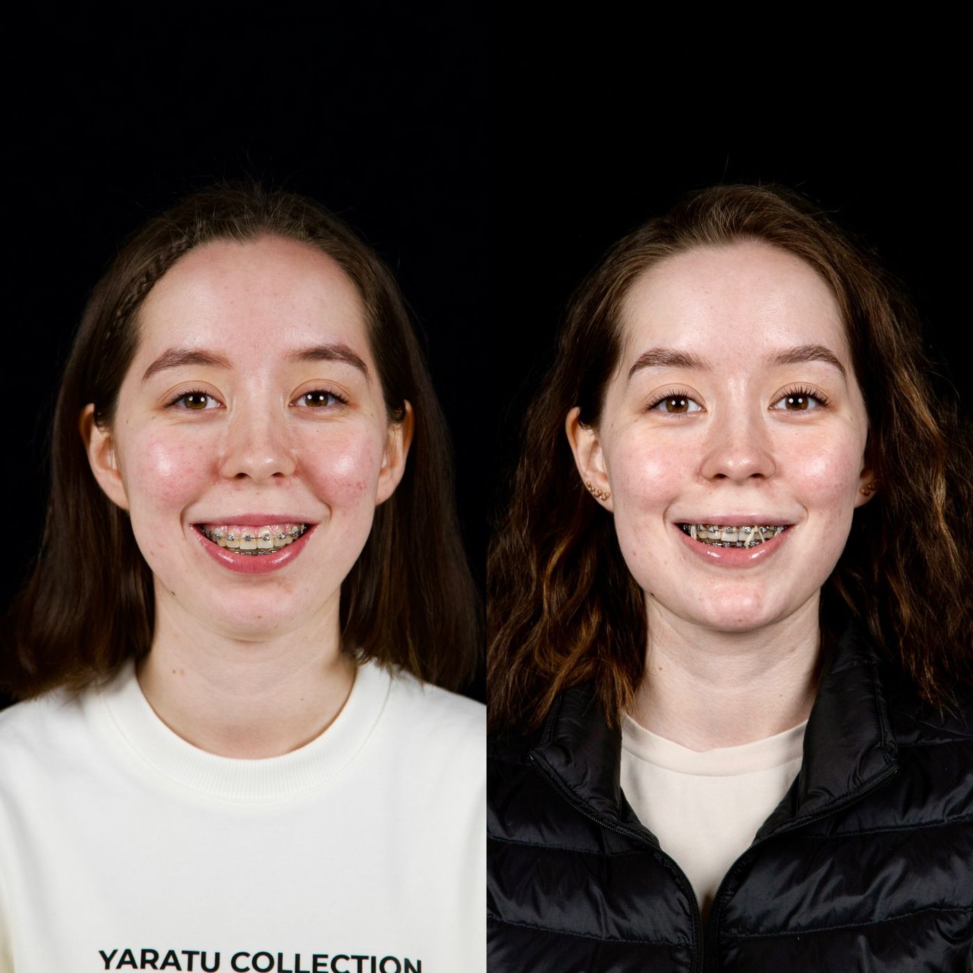 Class II skeletal malocclusion — gummy smile and chin — before and after, photo 1