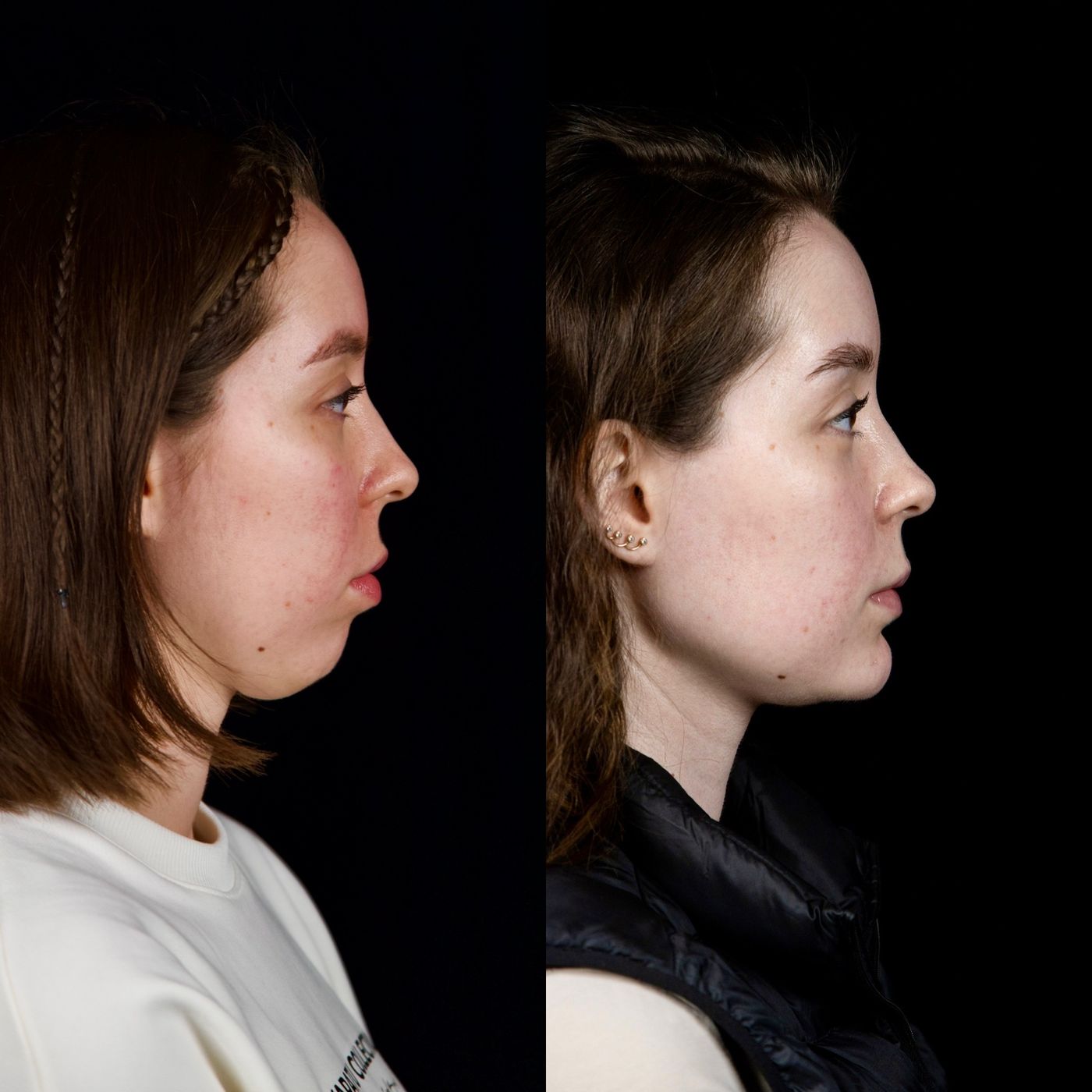 Class II skeletal malocclusion — gummy smile and chin — before and after, photo 2
