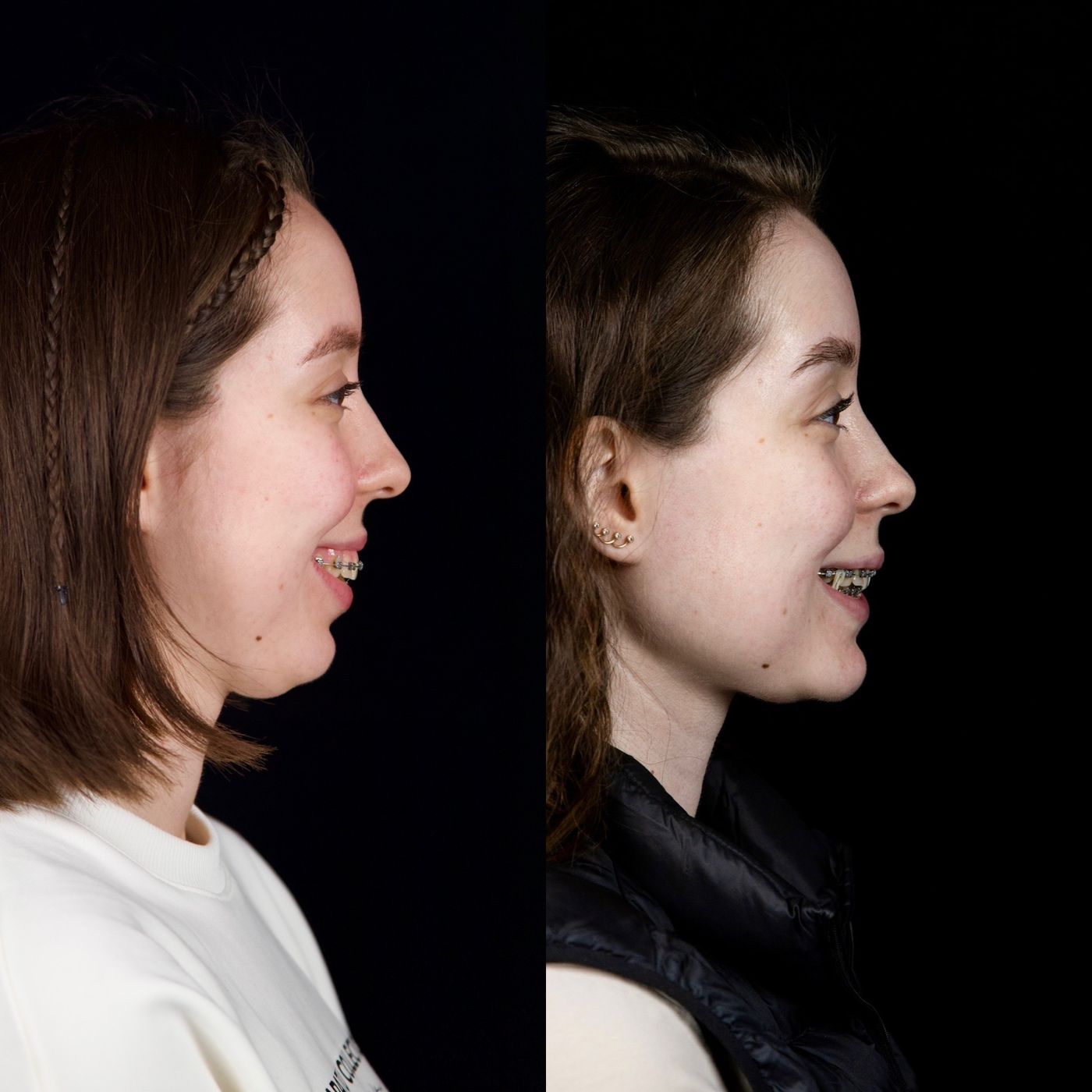 Class II skeletal malocclusion — gummy smile and chin — before and after, photo 3