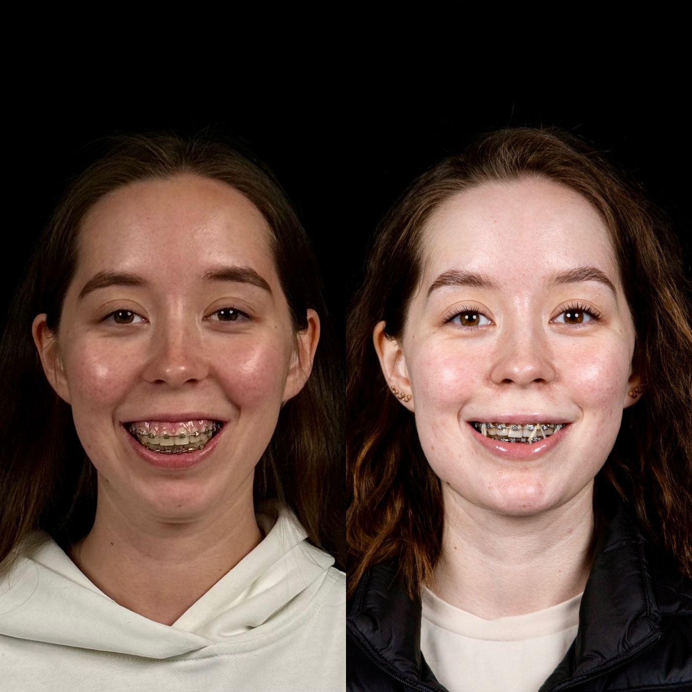 Class II skeletal malocclusion — gummy smile and chin — before and after, photo 4