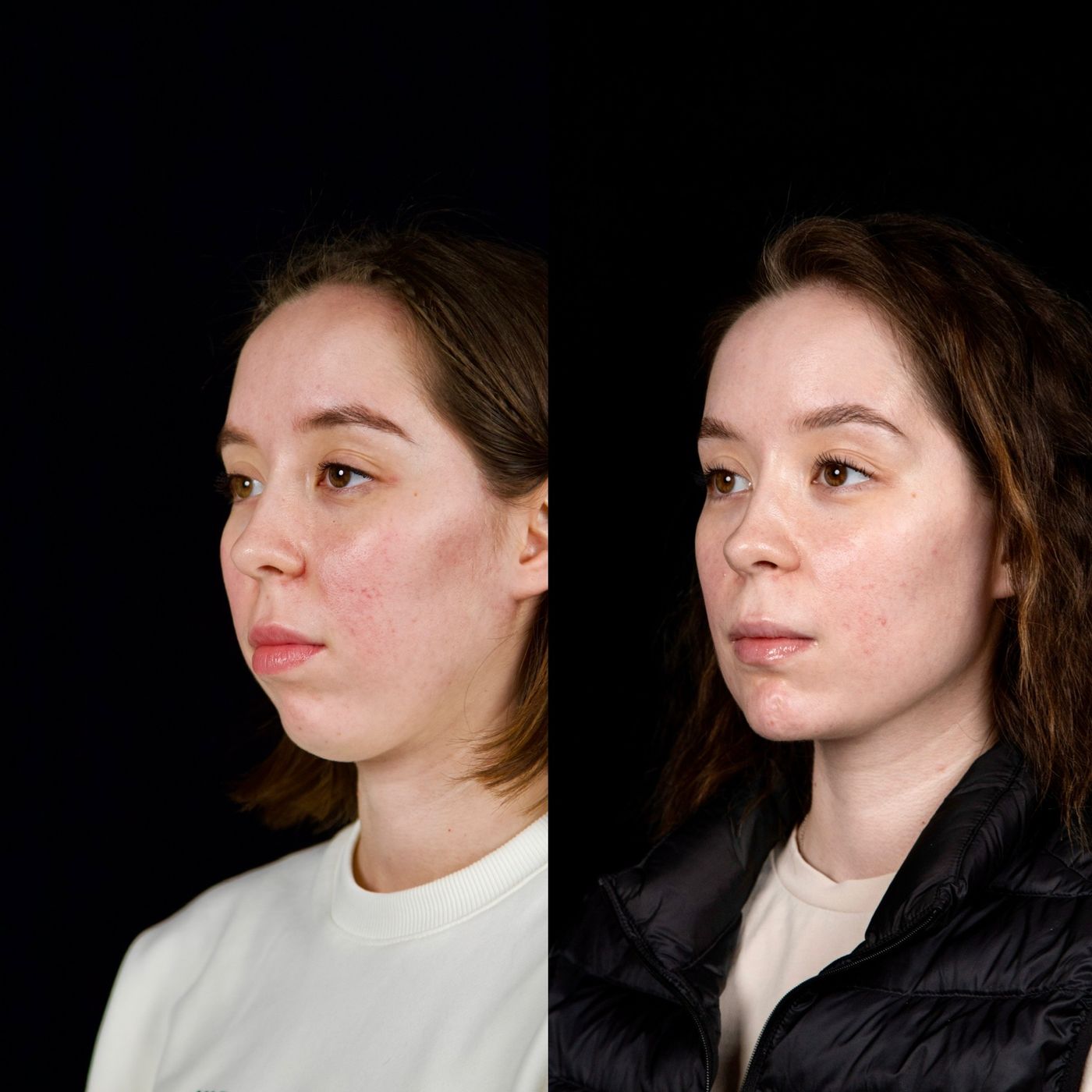 Class II skeletal malocclusion — gummy smile and chin — before and after, photo 5