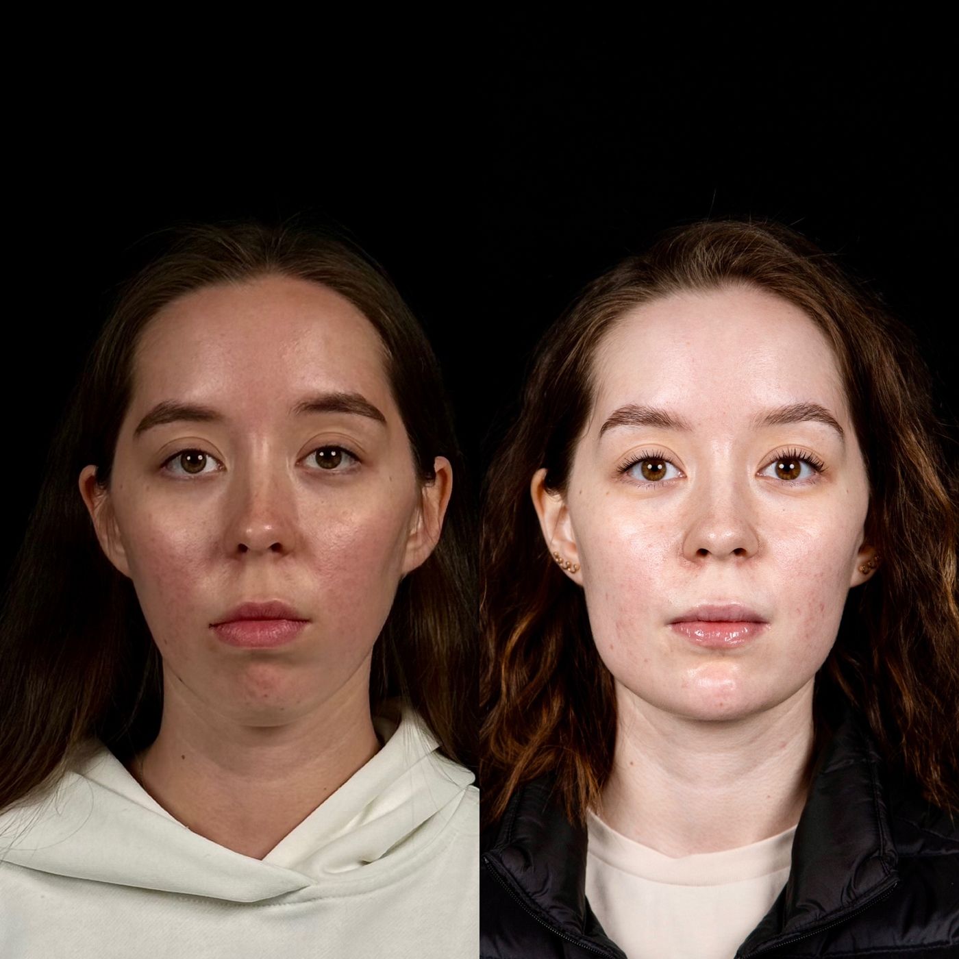 Class II skeletal malocclusion — gummy smile and chin — before and after, photo 6