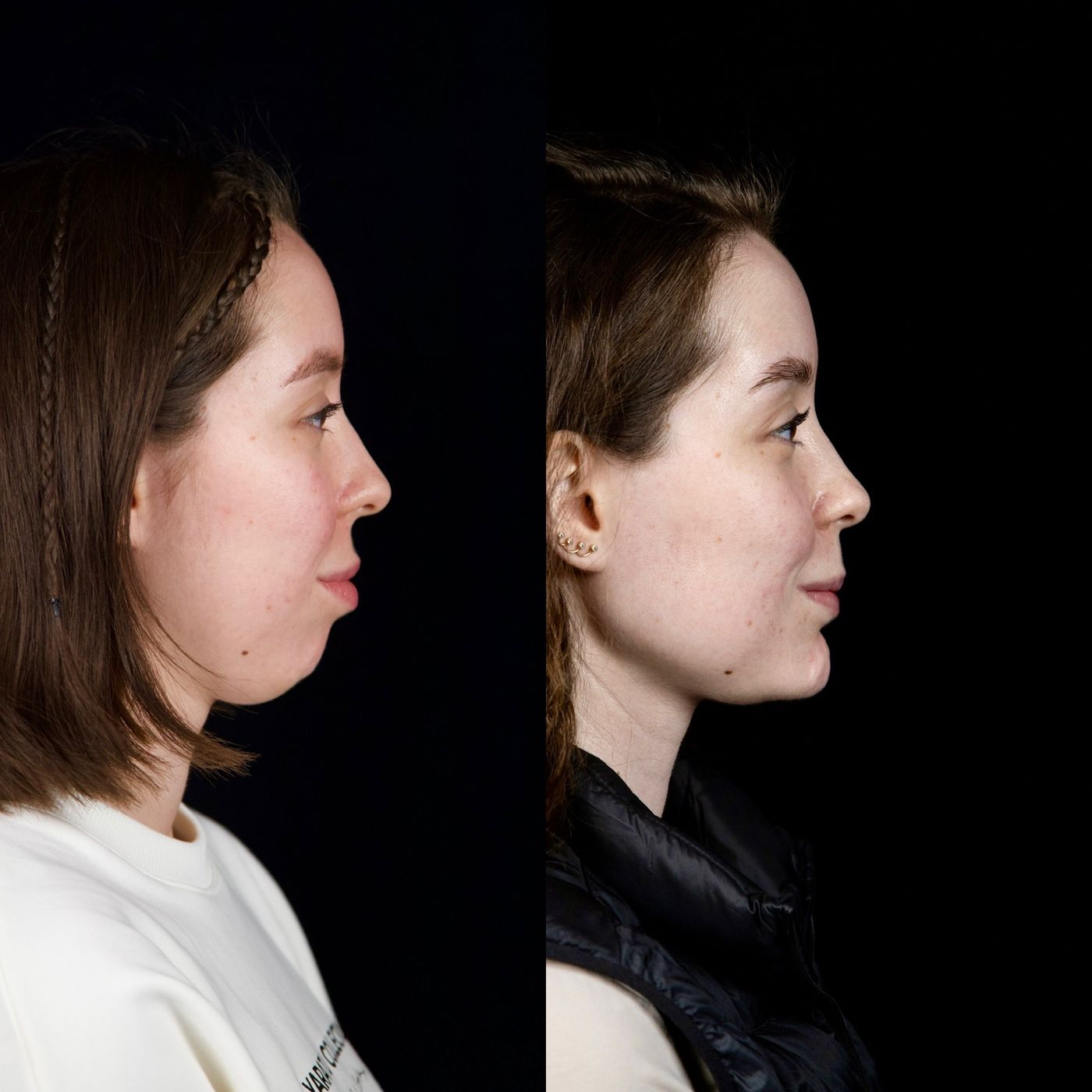 Class II skeletal malocclusion — gummy smile and chin — before and after, photo 7