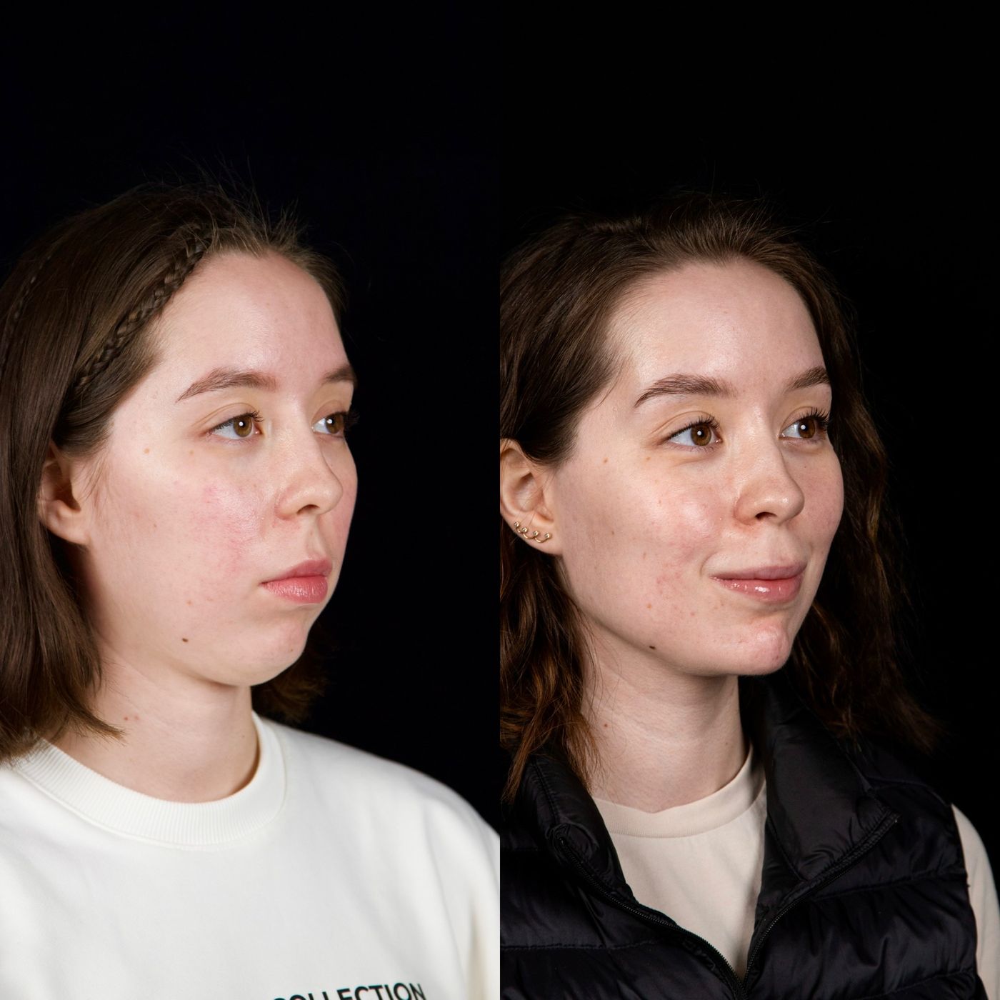 Class II skeletal malocclusion — gummy smile and chin — before and after, photo 8