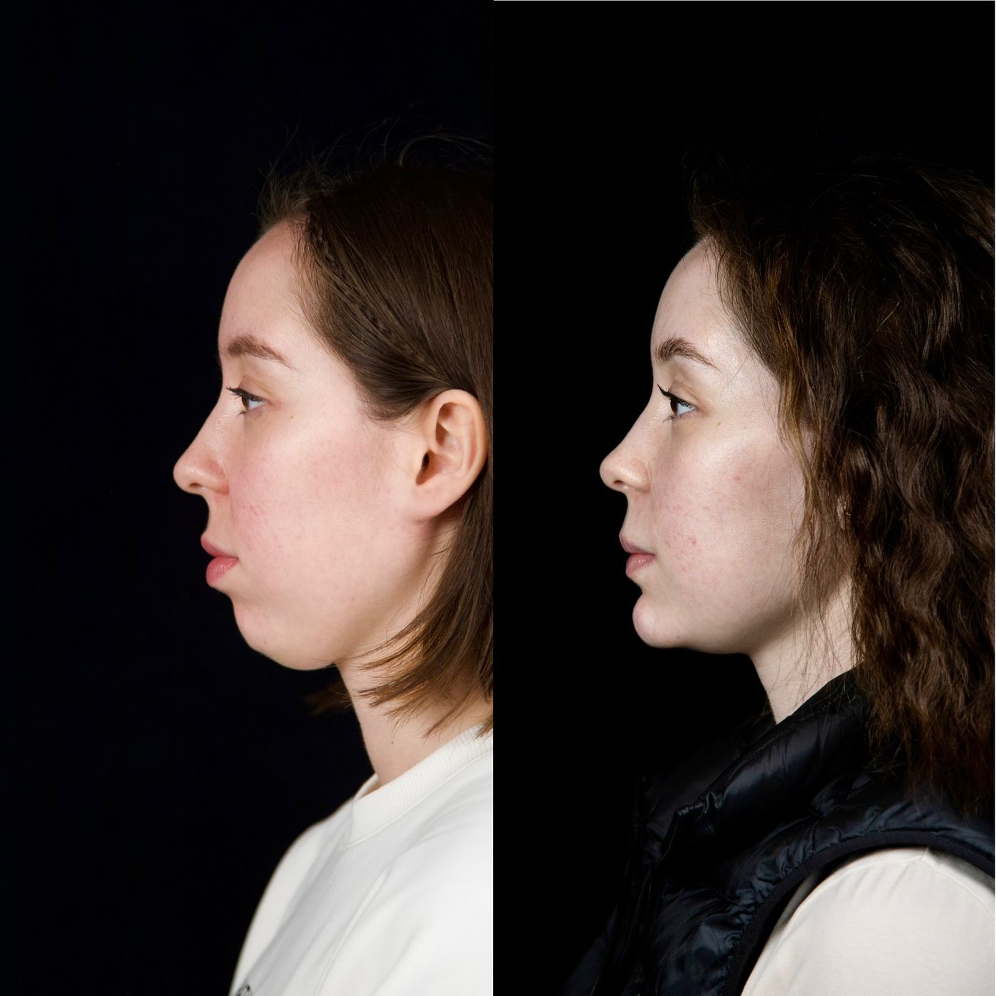 Class II skeletal malocclusion — gummy smile and chin — before and after, photo 9