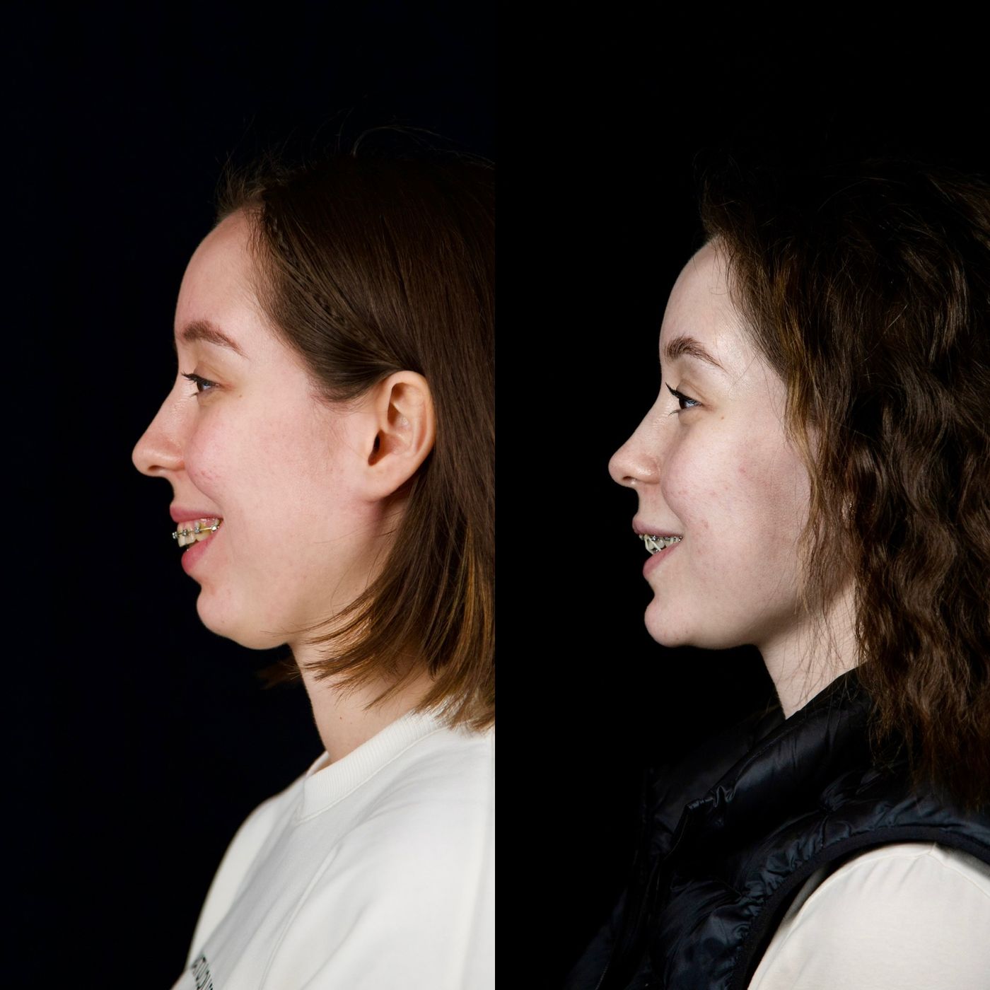Class II skeletal malocclusion — gummy smile and chin — before and after, photo 10