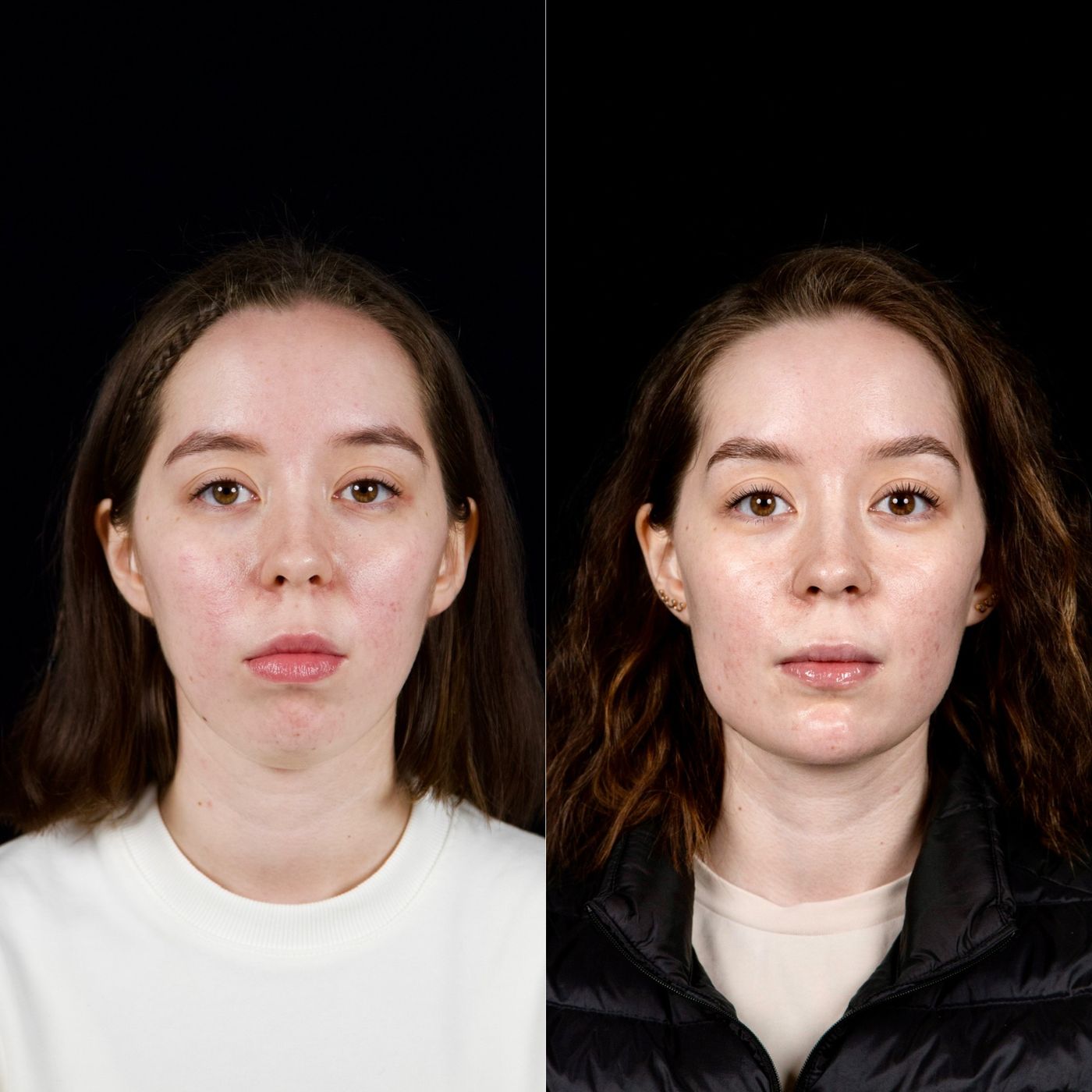 Class II skeletal malocclusion — gummy smile and chin — before and after, photo 11