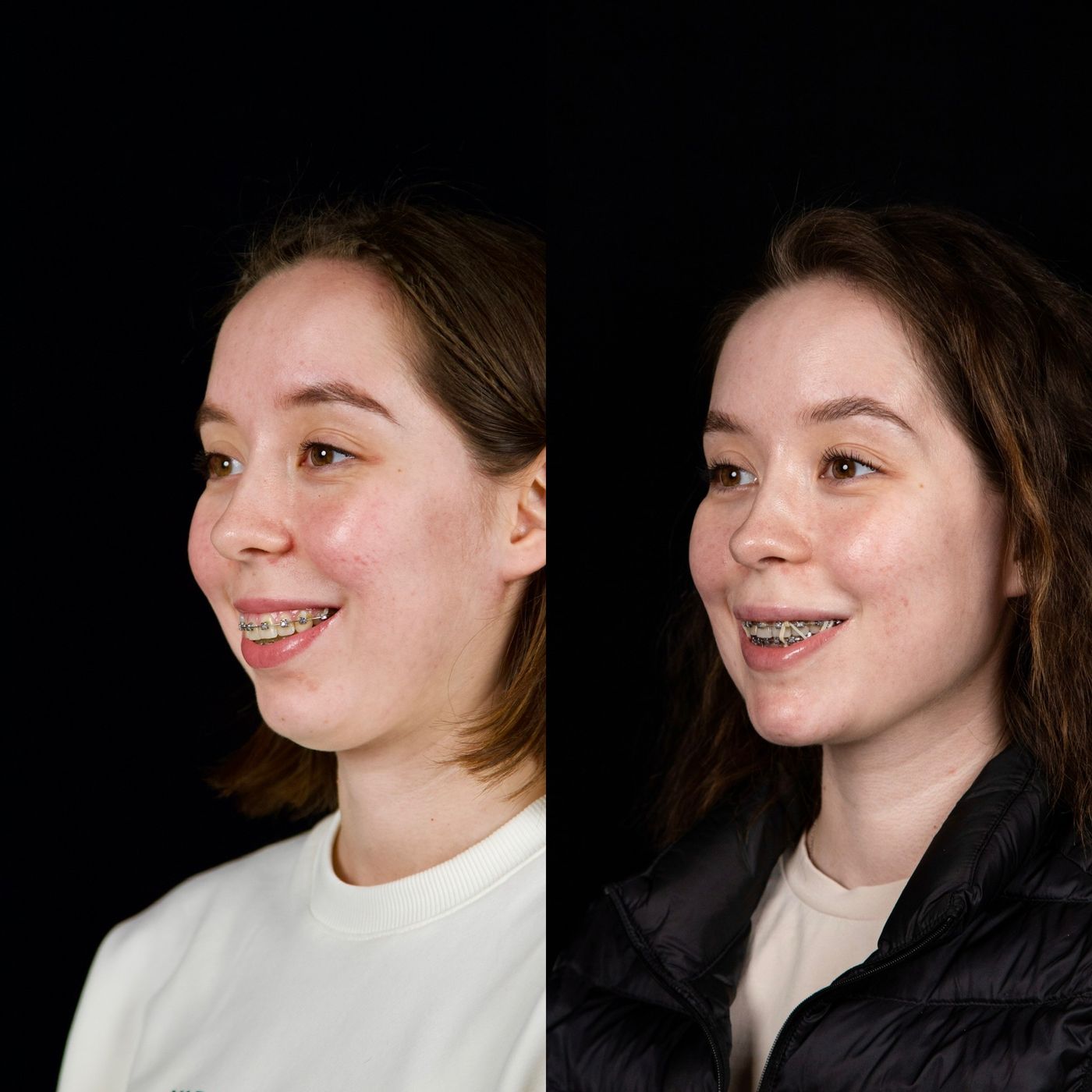 Class II skeletal malocclusion — gummy smile and chin — before and after, photo 12