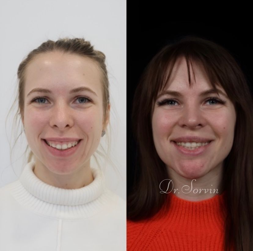 Class II skeletal malocclusion — gummy smile and rhinoplasty — before and after, photo 1