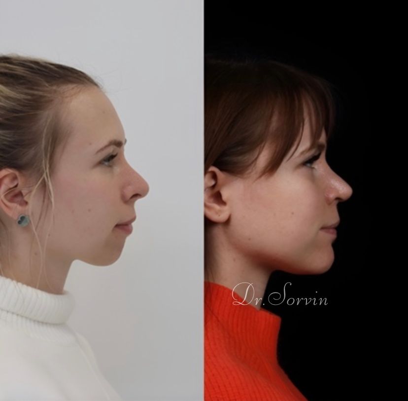 Class II skeletal malocclusion — gummy smile and rhinoplasty — before and after, photo 2