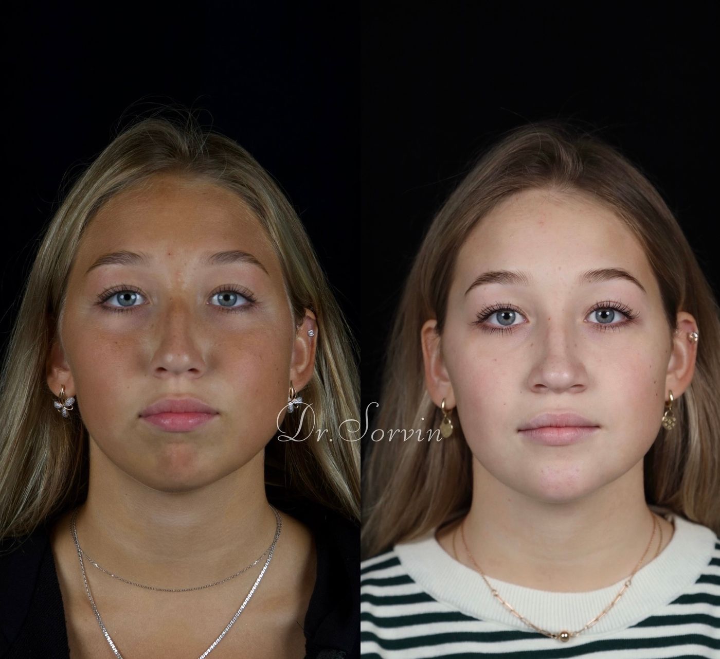 Class II skeletal malocclusion and anterior open bite — before and after, photo 1