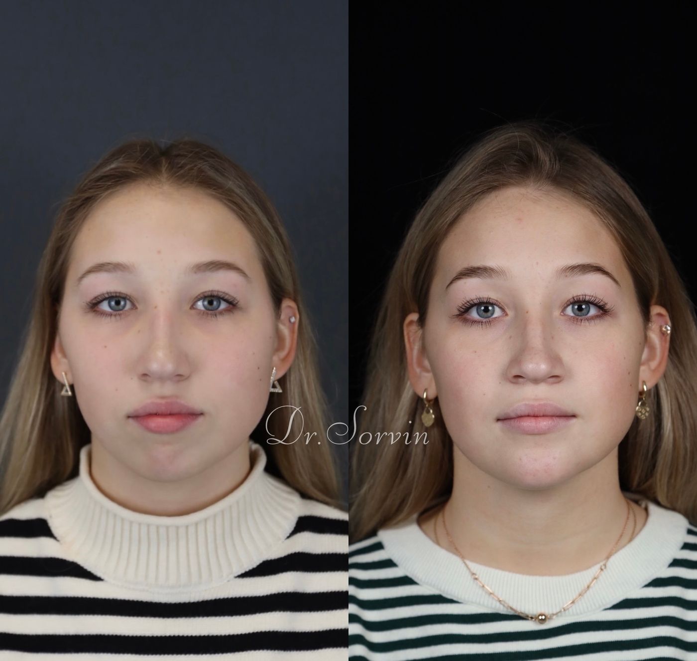 Class II skeletal malocclusion and anterior open bite — before and after, photo 2