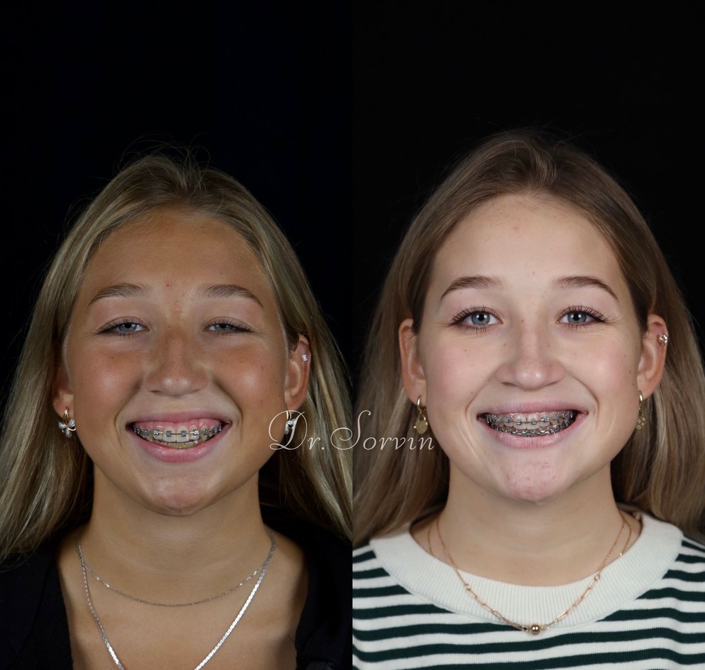 Class II skeletal malocclusion and anterior open bite — before and after, photo 3