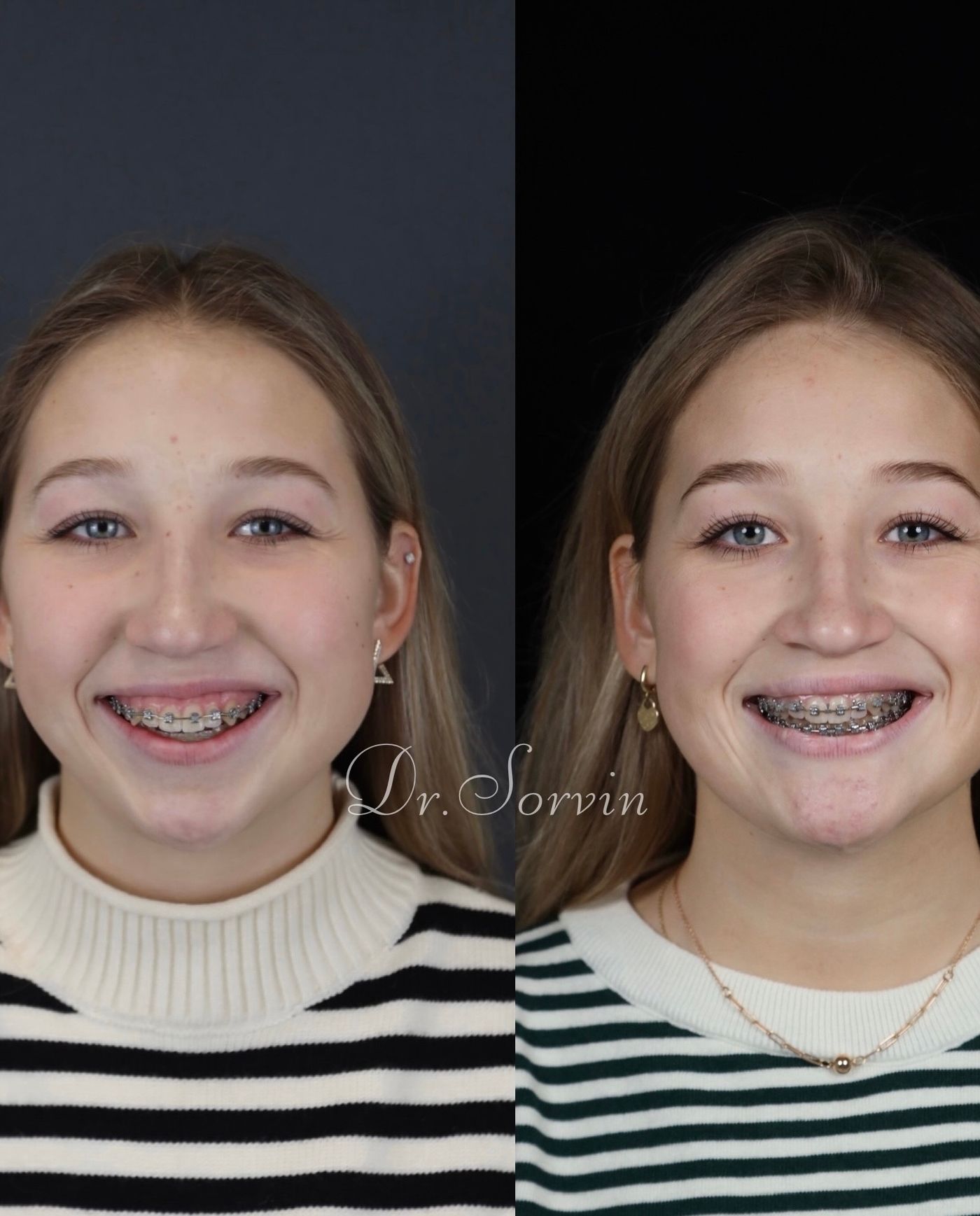 Class II skeletal malocclusion and anterior open bite — before and after, photo 4