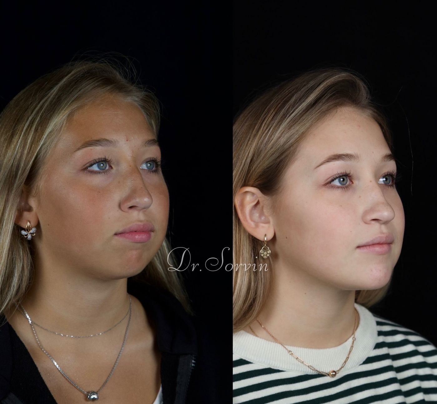 Class II skeletal malocclusion and anterior open bite — before and after, photo 5