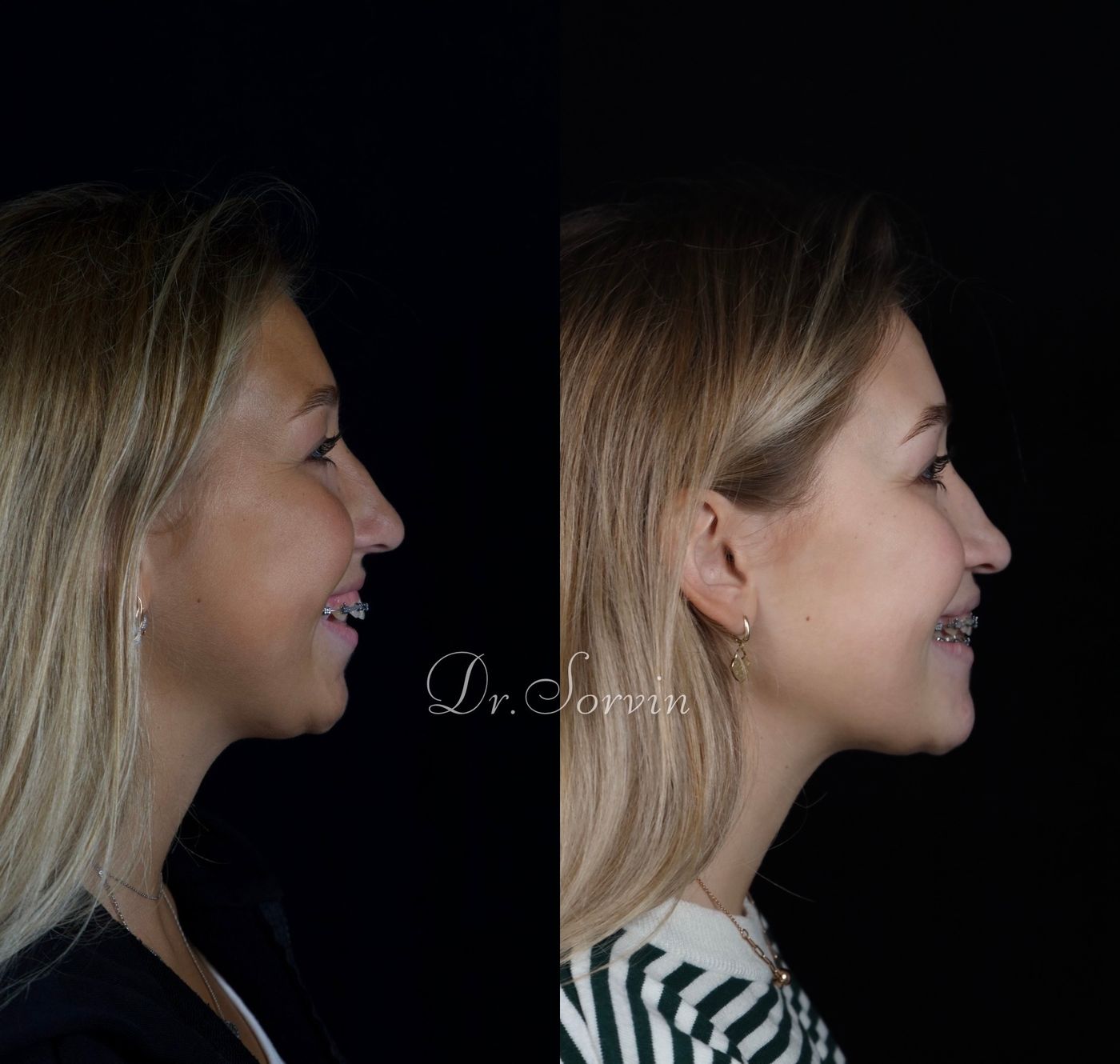 Class II skeletal malocclusion and anterior open bite — before and after, photo 6