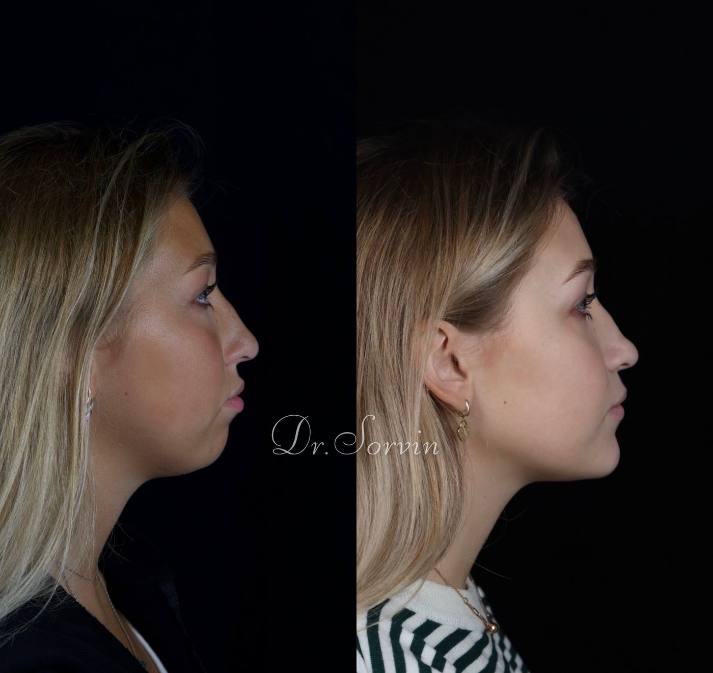 Class II skeletal malocclusion and anterior open bite — before and after, photo 7