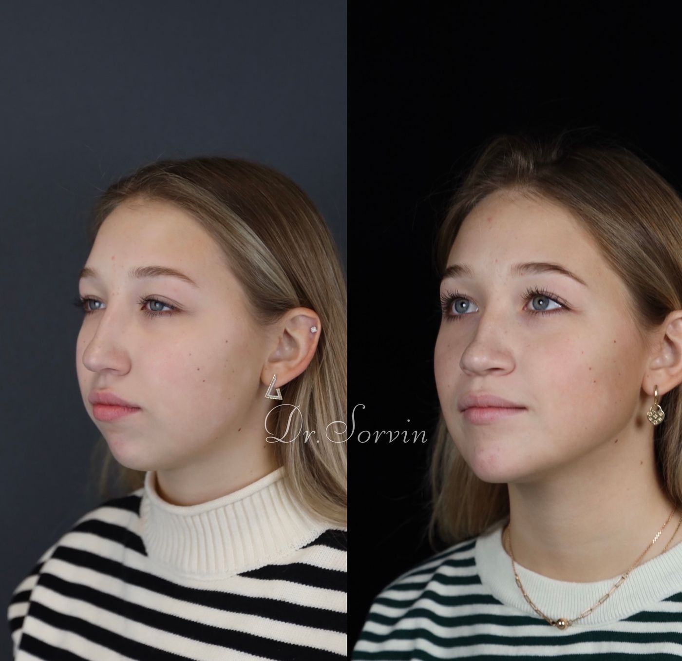 Class II skeletal malocclusion and anterior open bite — before and after, photo 8