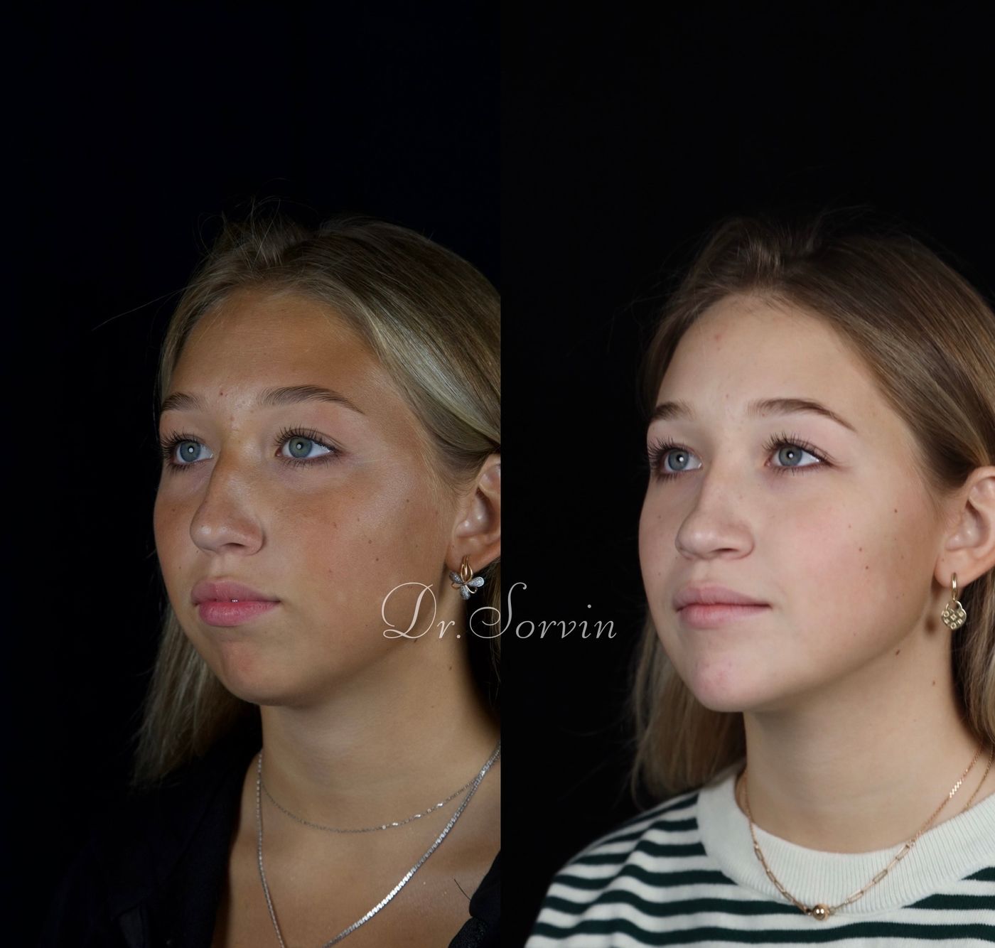 Class II skeletal malocclusion and anterior open bite — before and after, photo 9