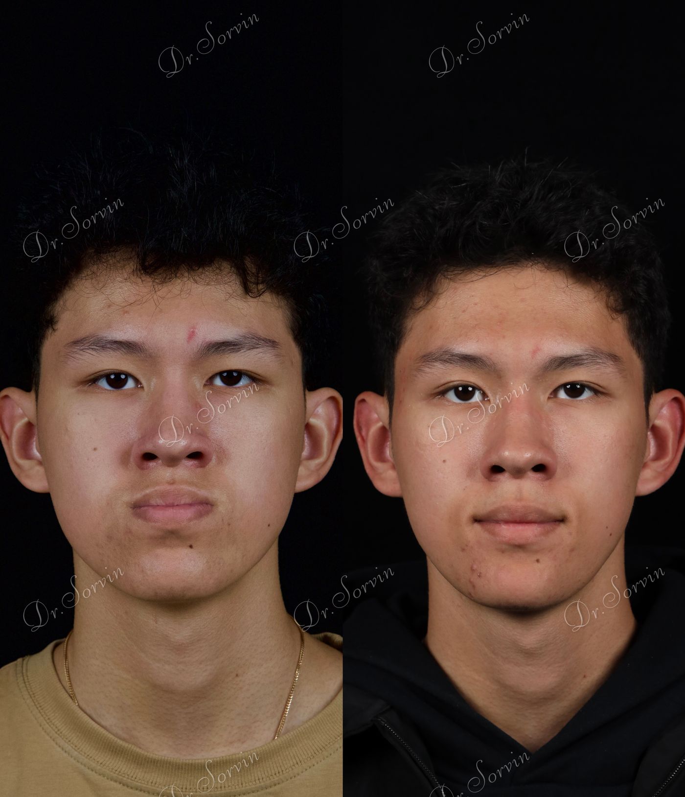 Class III skeletal malocclusion — 5 — before and after, photo 1