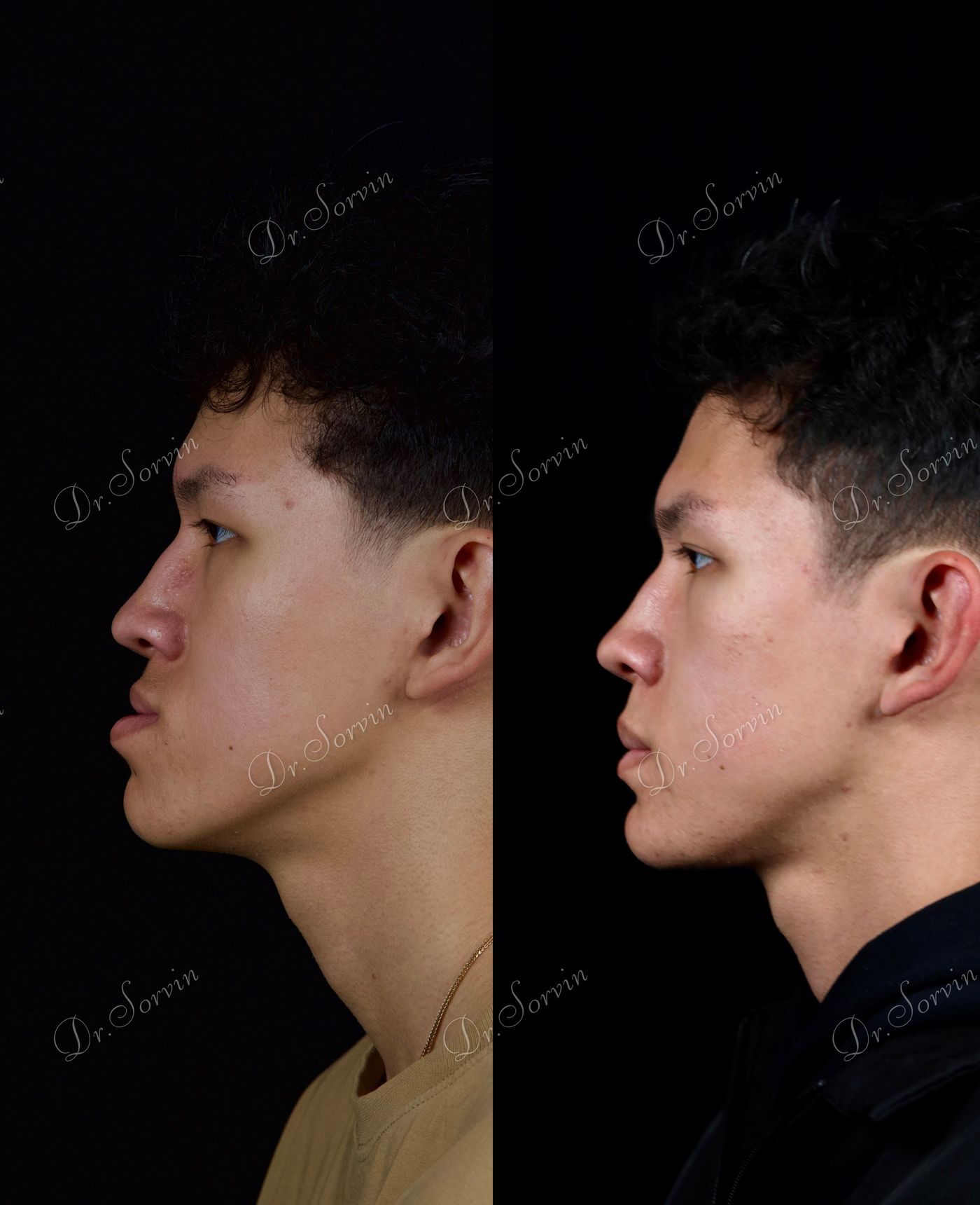 Class III skeletal malocclusion — 5 — before and after, photo 2