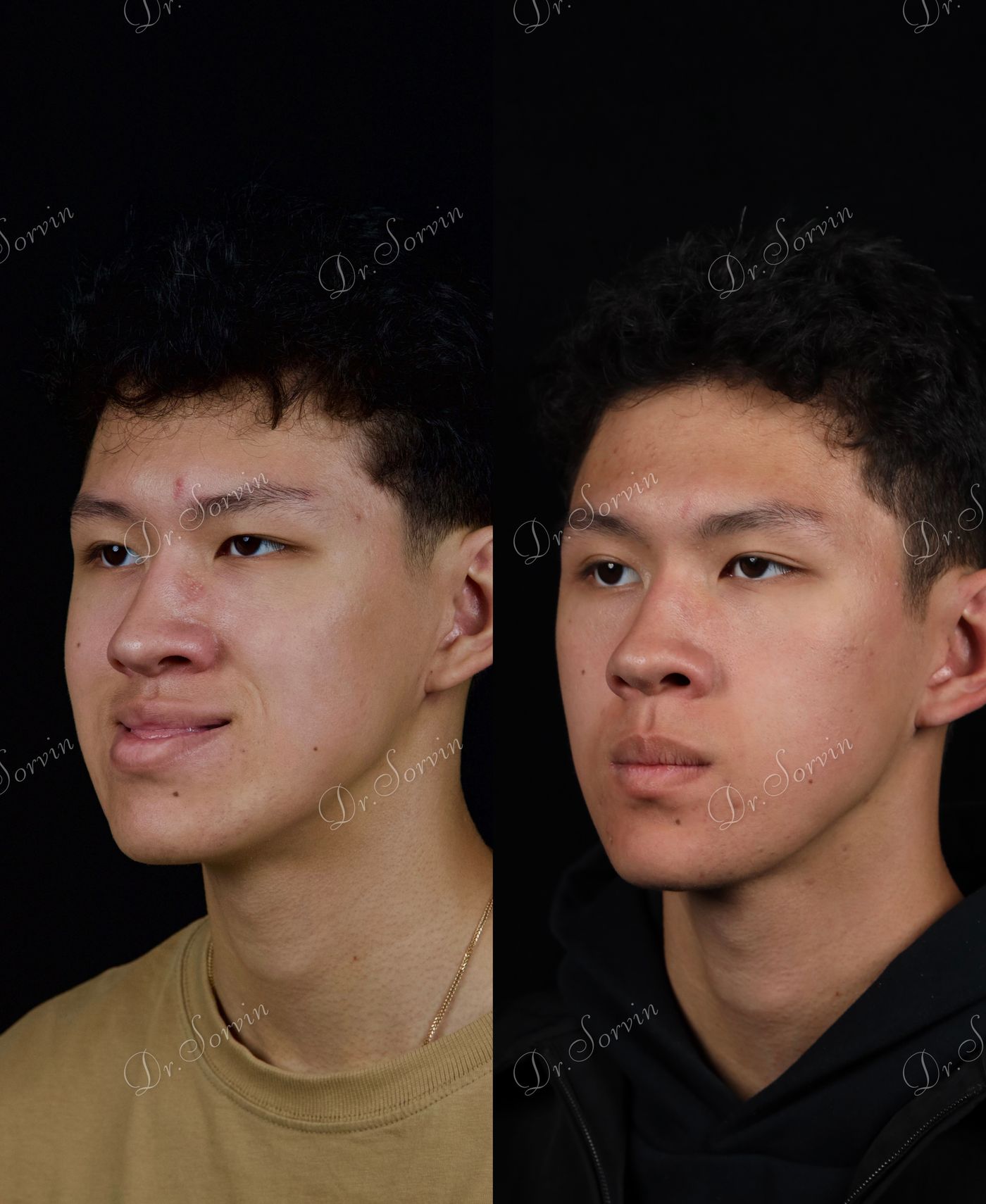 Class III skeletal malocclusion — 5 — before and after, photo 3