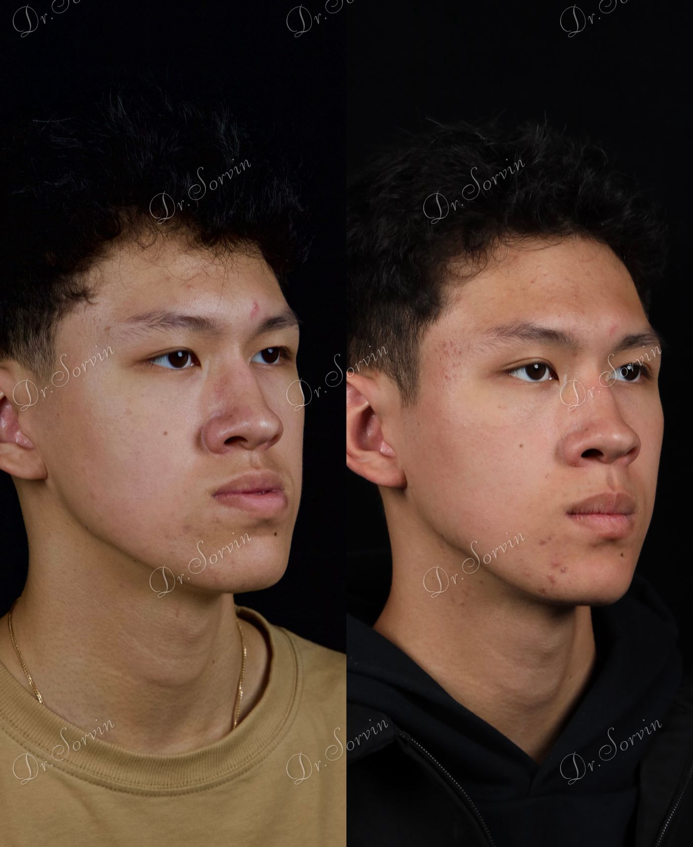 Class III skeletal malocclusion — 5 — before and after, photo 4