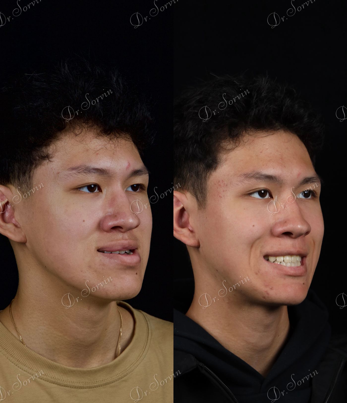 Class III skeletal malocclusion — 5 — before and after, photo 5