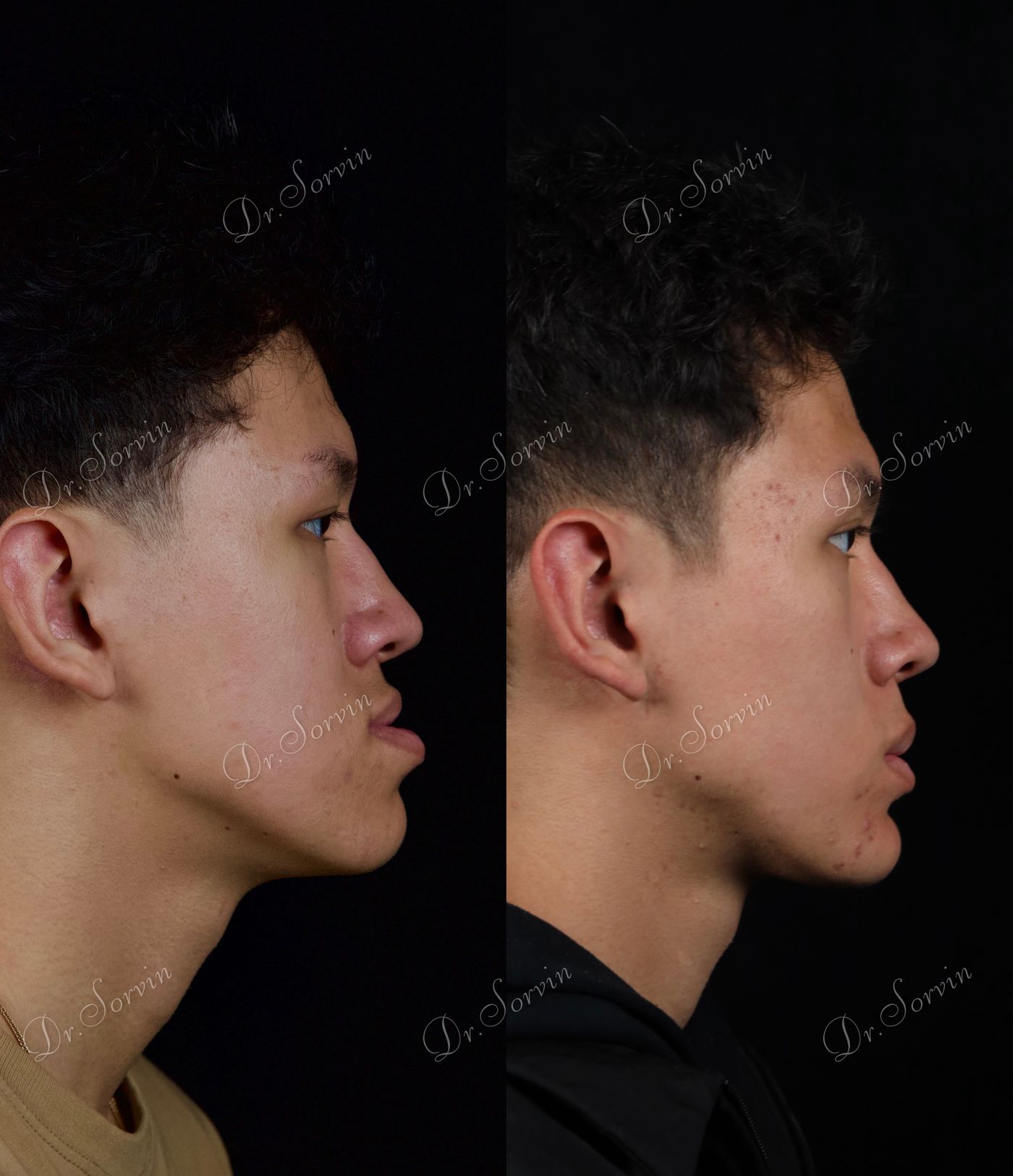 Class III skeletal malocclusion — 5 — before and after, photo 6