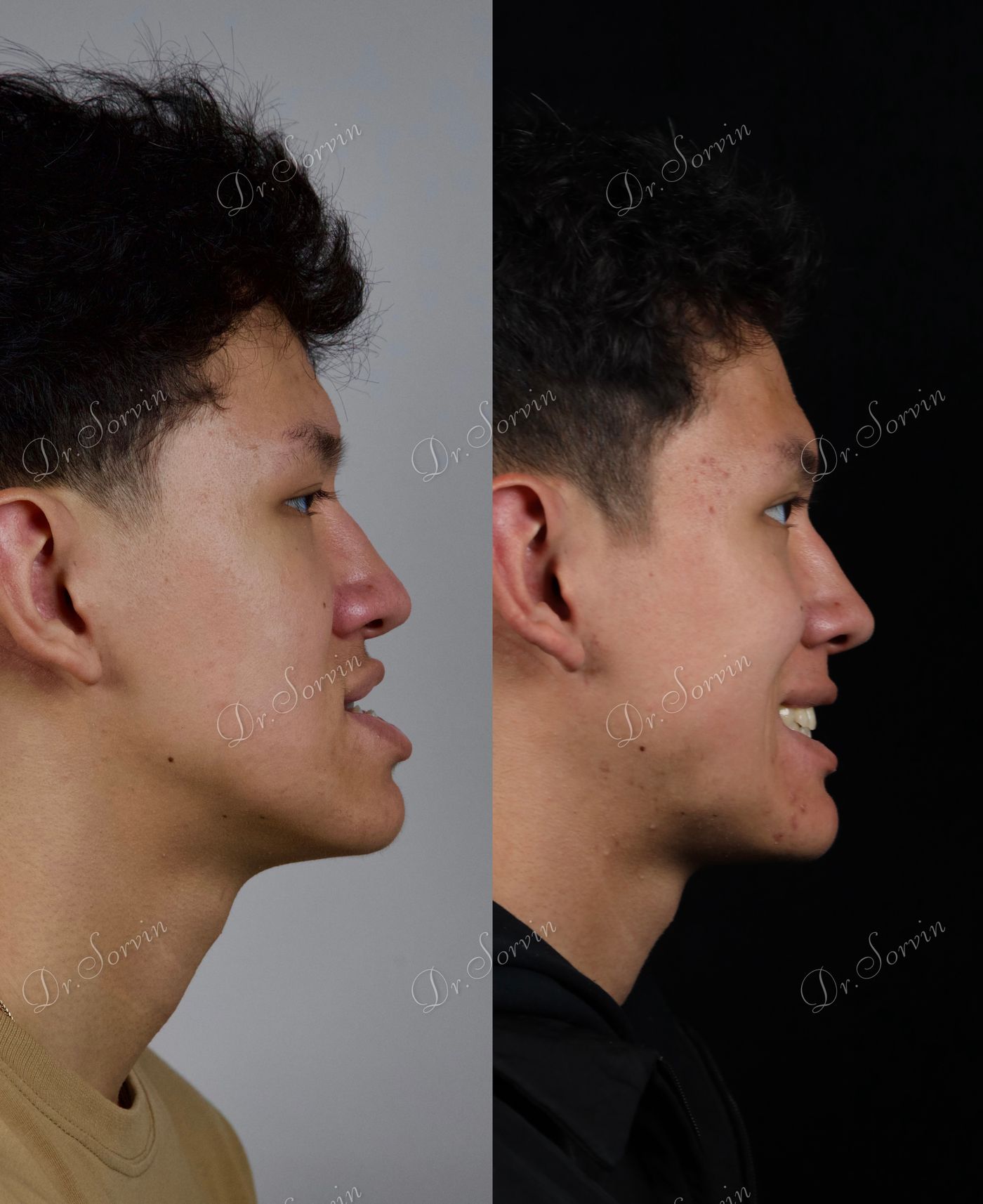 Class III skeletal malocclusion — 5 — before and after, photo 7