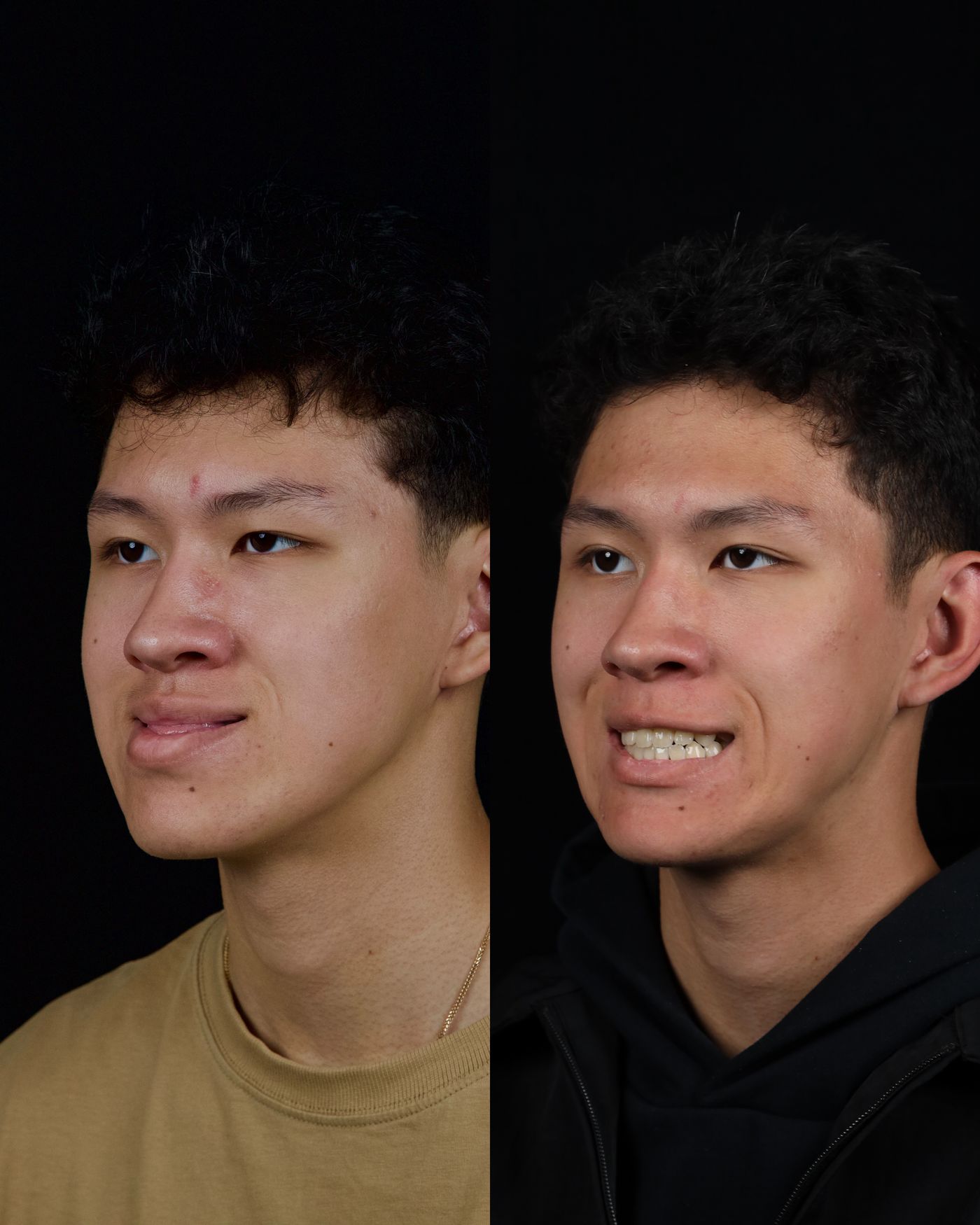 Class III skeletal malocclusion — 5 — before and after, photo 8