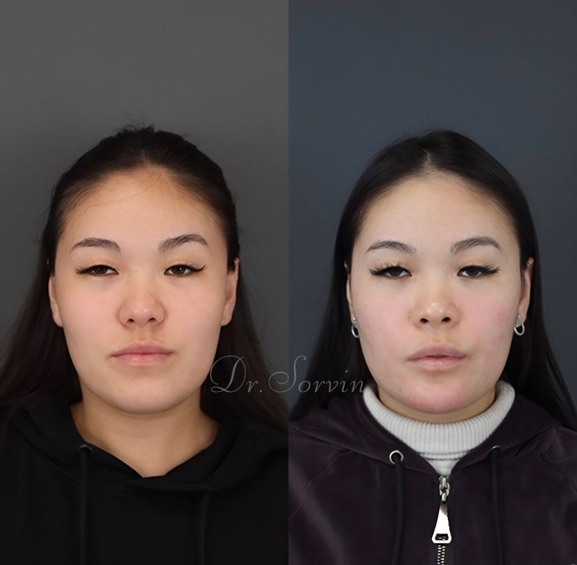 Class III skeletal malocclusion — 2 — before and after, photo 1