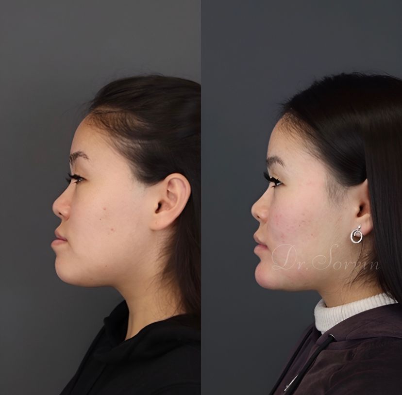 Class III skeletal malocclusion — 2 — before and after, photo 2