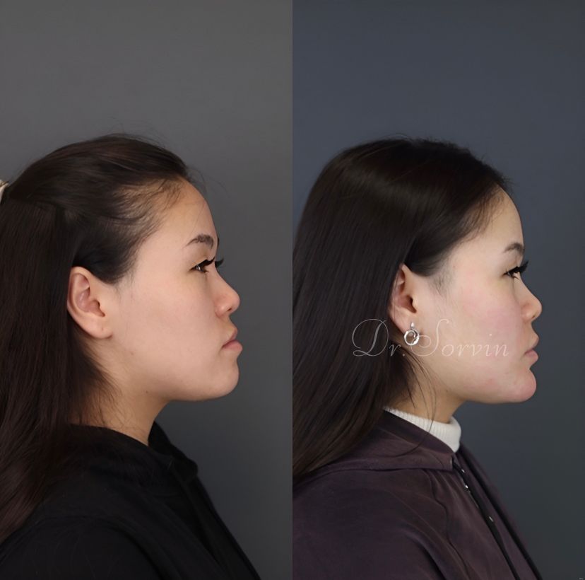 Class III skeletal malocclusion — 2 — before and after, photo 3