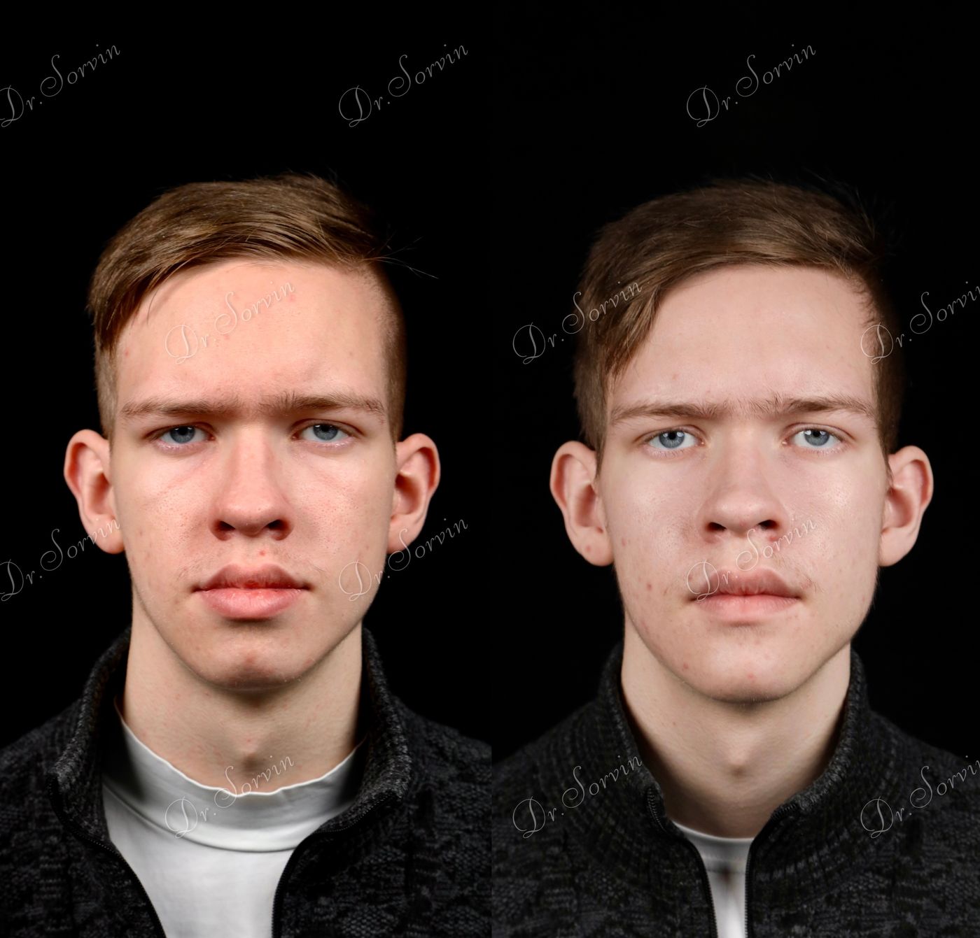 Class III skeletal malocclusion — 3 — before and after, photo 1