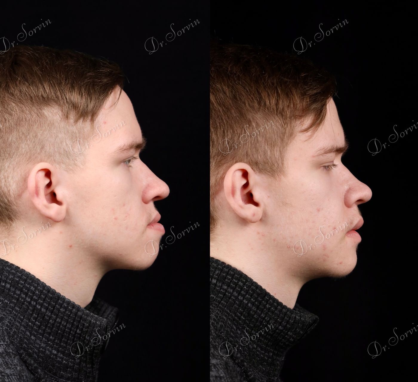 Class III skeletal malocclusion — 3 — before and after, photo 2