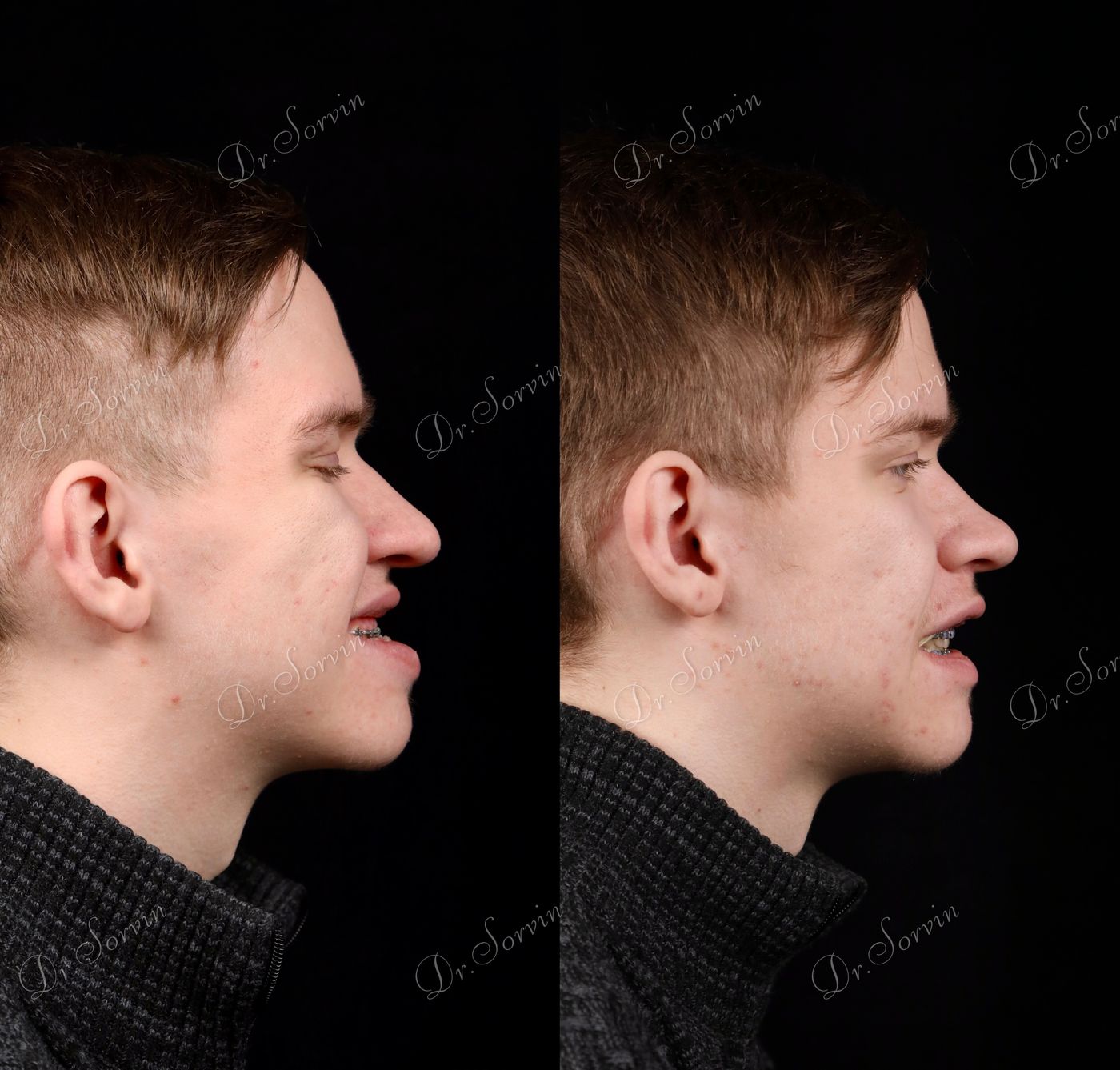 Class III skeletal malocclusion — 3 — before and after, photo 3